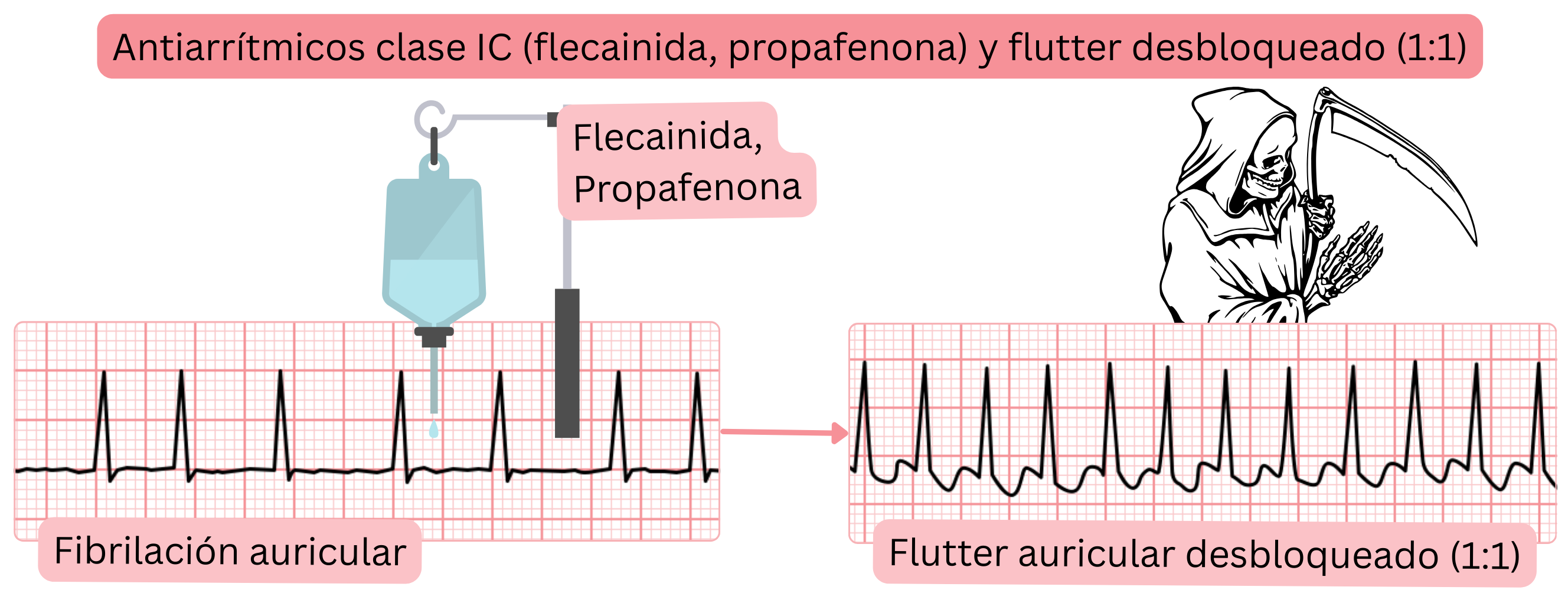 Esquema del efecto de los antiarrítmicos de clase IC sin bloqueo concomitante del nodo AV que muestra el riesgo de conversión de la fibrilación auricular a flutter auricular no bloqueado con conducción 1:1.