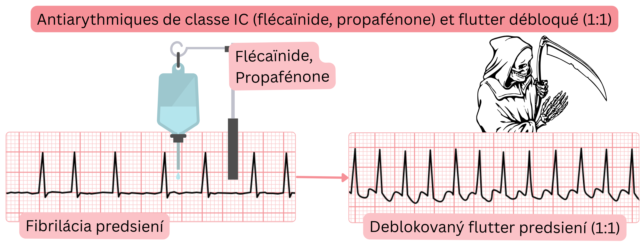Schéma de l’effet des antiarythmiques de classe IC sans blocage concomitant du nœud AV illustrant le risque de transformation de la fibrillation auriculaire en flutter auriculaire non bloqué avec conduction 1:1.