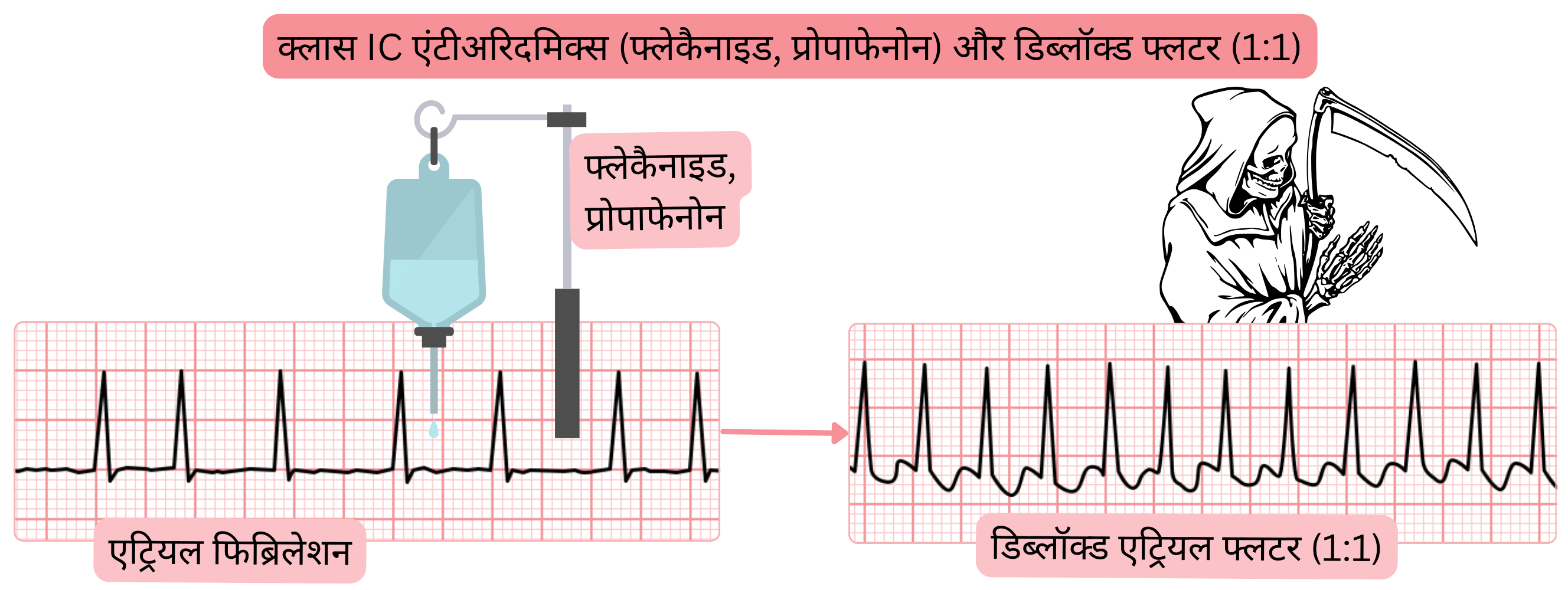 एवी नोड ब्लॉकेड के बिना क्लास IC एंटीएरिदमिक दवाओं के प्रभाव का आरेख, जिसमें एट्रियल फिब्रिलेशन के 1:1 संचरण वाले अनब्लॉक्ड एट्रियल फ्लटर में बदलने के जोखिम को दर्शाया गया है।