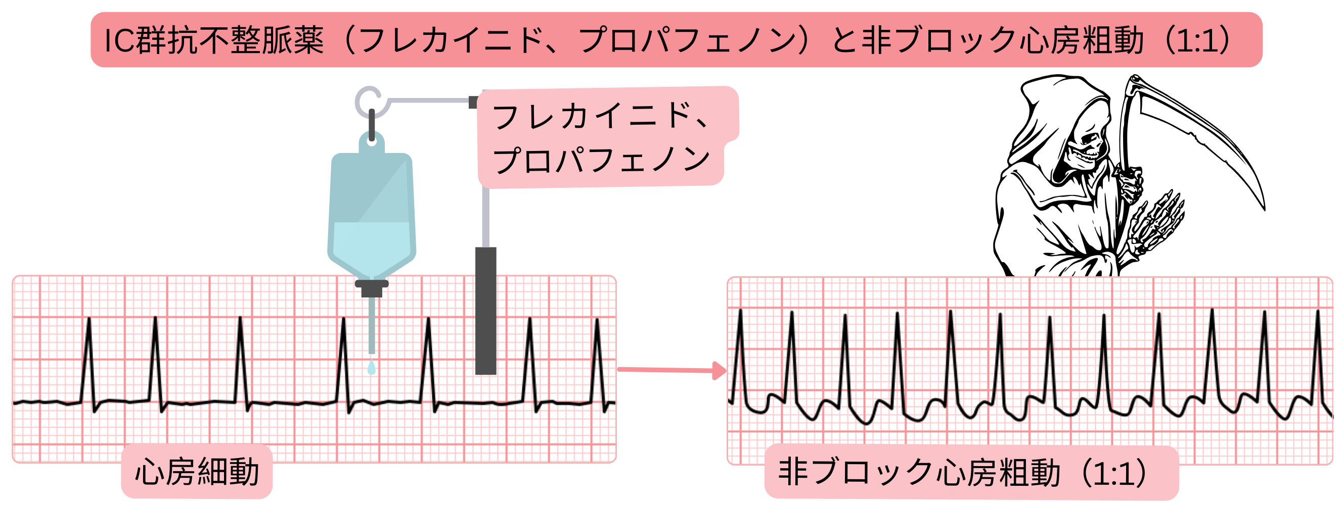 房室結節遮断を伴わないIC群抗不整脈薬の作用を示す模式図で、心房細動が1:1房室伝導を伴う非遮断性心房粗動へ移行するリスクを示す。