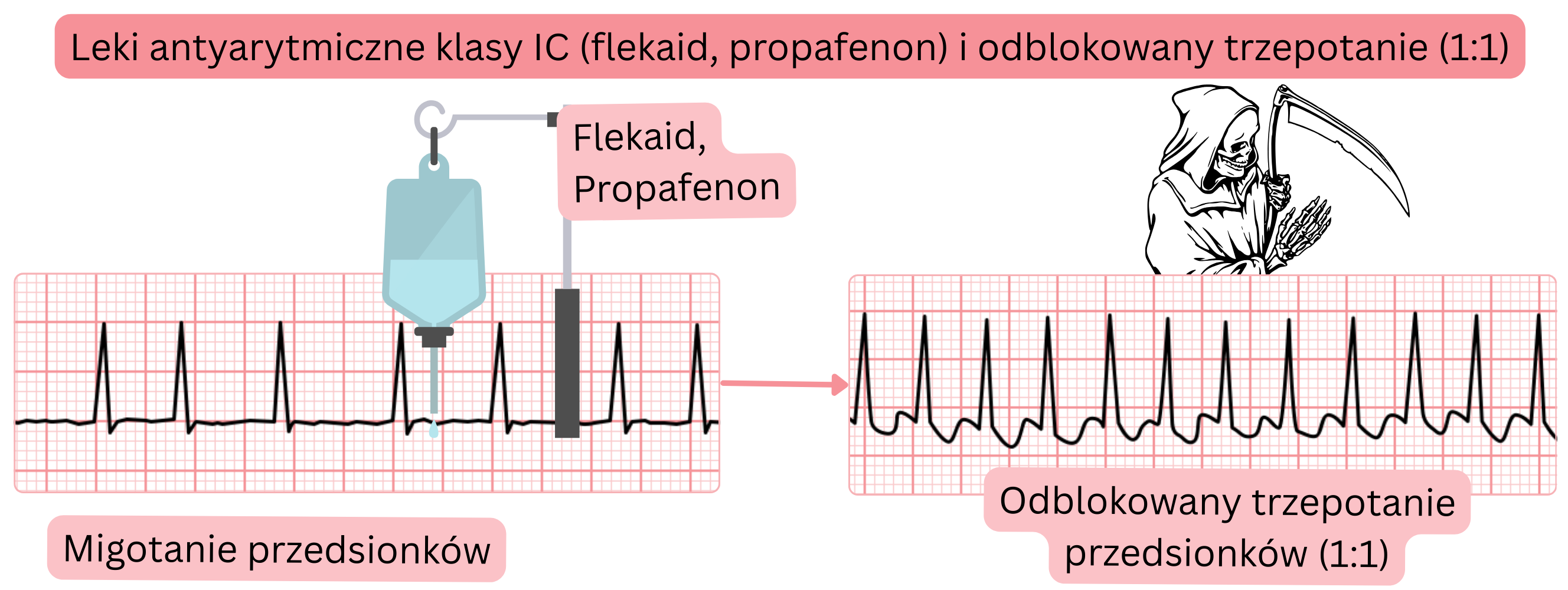 Schemat działania leków antyarytmicznych klasy IC bez jednoczesnej blokady węzła AV, przedstawiający ryzyko przejścia migotania przedsionków w odblokowane trzepotanie przedsionków z przewodzeniem 1:1.