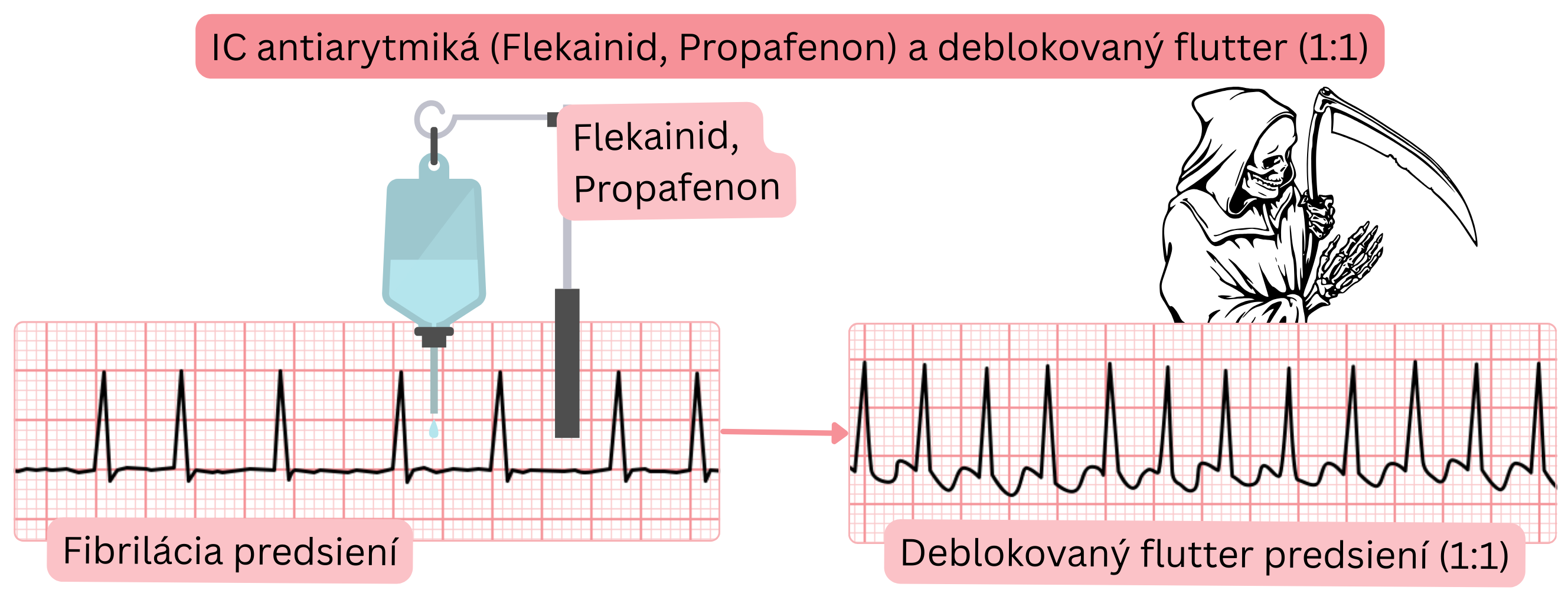 Schéma účinku antiarytmík triedy IC bez súčasnej blokády AV uzla znázorňujúca riziko prechodu fibrilácie predsiení do deblokovaného predsieňového flutteru s vedením 1 : 1.