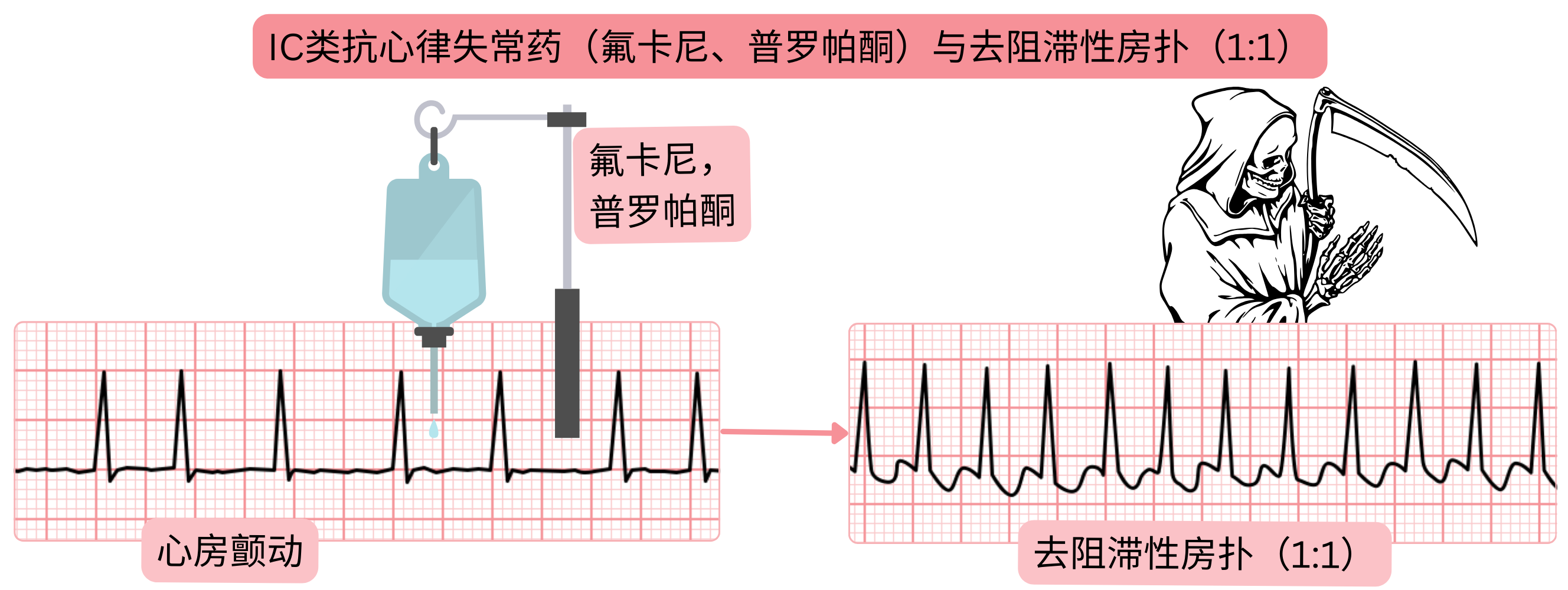 IC类抗心律失常药物在未同时阻滞房室结情况下的作用示意图，显示心房颤动转变为去阻滞的心房扑动并出现1:1传导的风险。