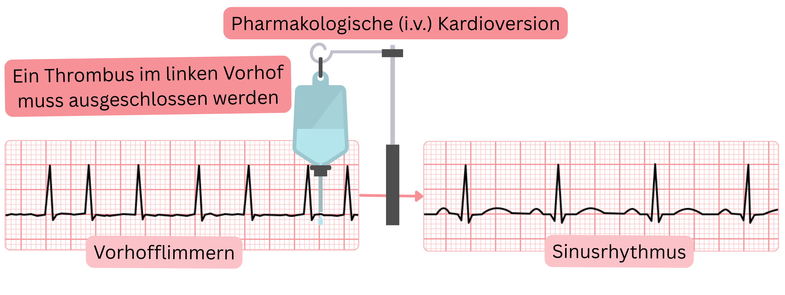 Schema der pharmakologischen Kardioversion von Vorhofflimmern mit intravenösen Antiarrhythmika unter Notwendigkeit des Ausschlusses eines Thrombus im linken Vorhof vor Wiederherstellung des Sinusrhythmus.