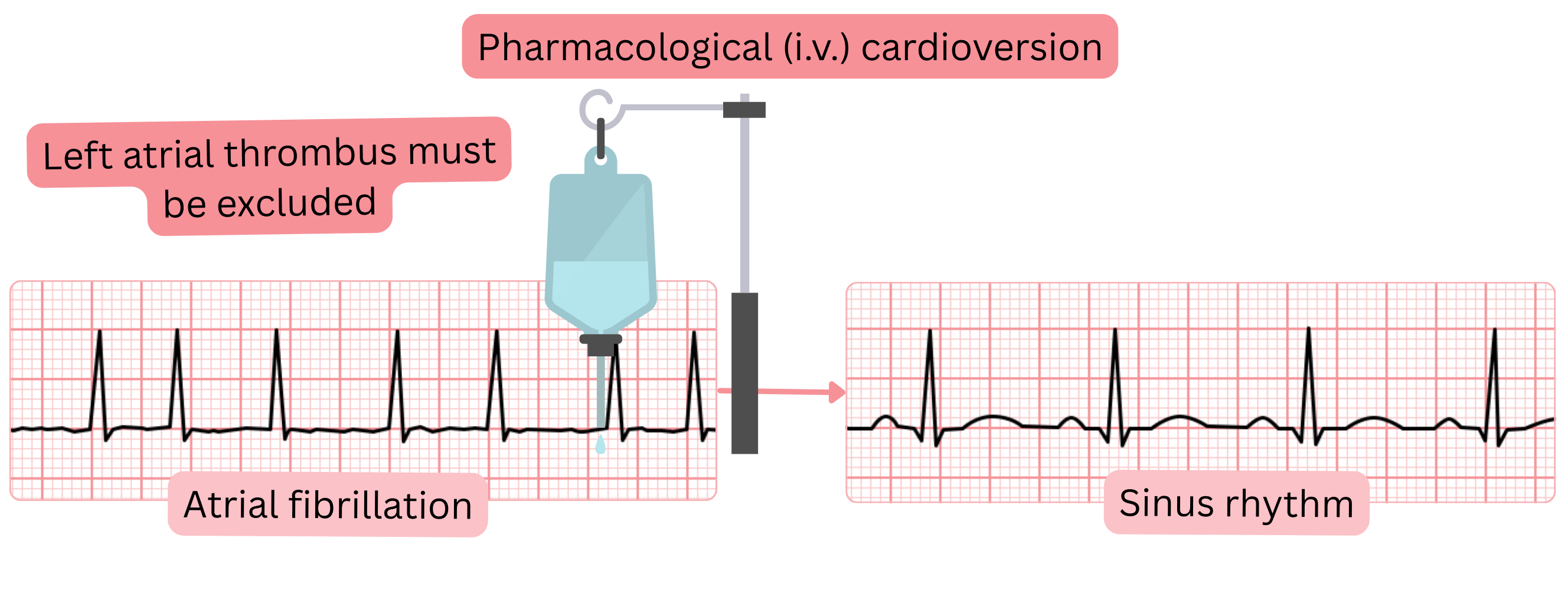Diagram of pharmacological cardioversion of atrial fibrillation using intravenous antiarrhythmic drugs, highlighting the need to exclude left atrial thrombus before restoration of sinus rhythm.