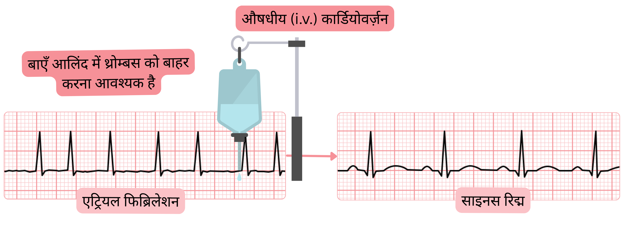इंट्रावेनस एंटीएरिदमिक दवाओं द्वारा एट्रियल फिब्रिलेशन की औषधीय कार्डियोवर्ज़न का आरेख, जिसमें साइनस रिद्म की पुनःस्थापना से पहले बाएँ एट्रियम में थ्रोम्बस को排除 करने की आवश्यकता दर्शाई गई है।