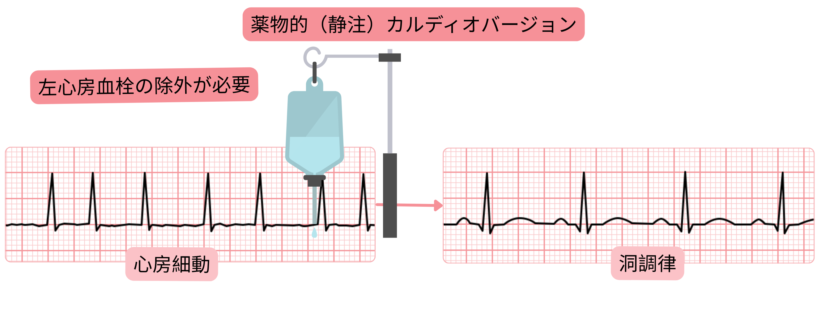 静脈内抗不整脈薬による心房細動の薬物的カルディオバージョンを示す模式図で、洞調律回復前に左心房血栓を除外する必要性を示す。