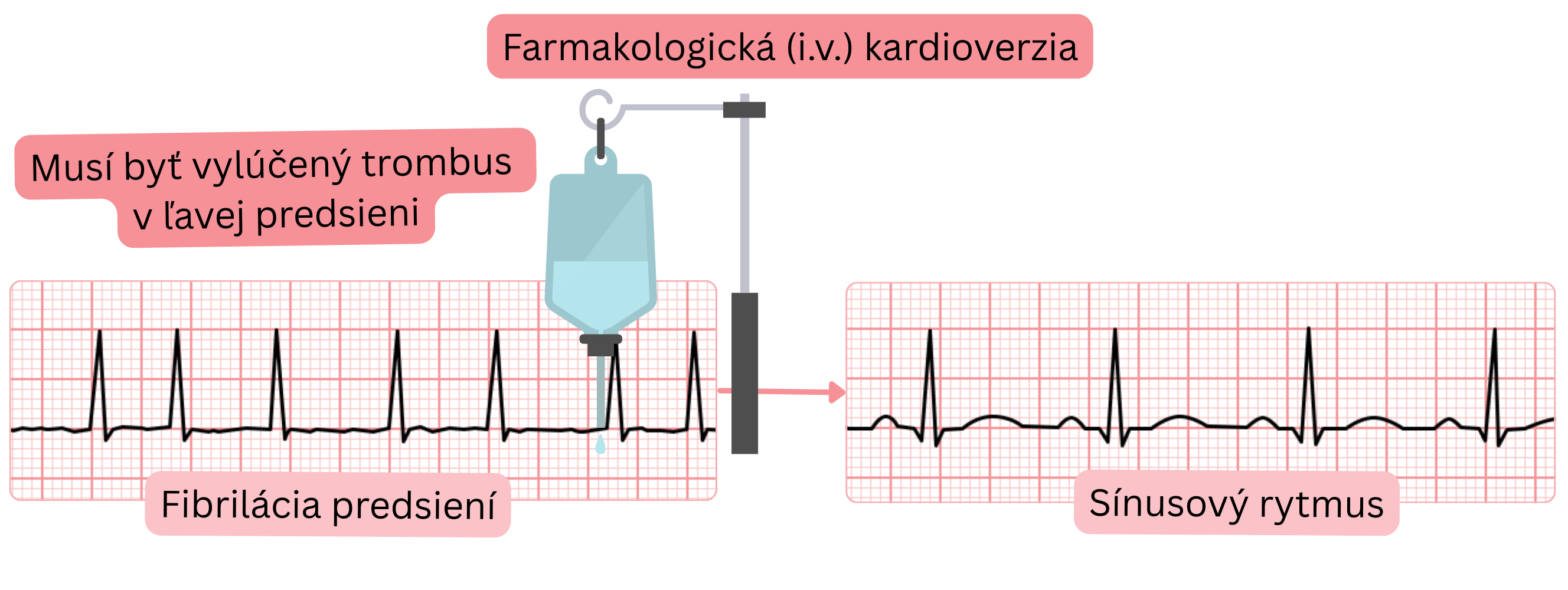 Schéma farmakologickej kardioverzie fibrilácie predsiení intravenóznymi antiarytmikami s nutnosťou vylúčenia trombu v ľavej predsieni pred obnovením sínusového rytmu.