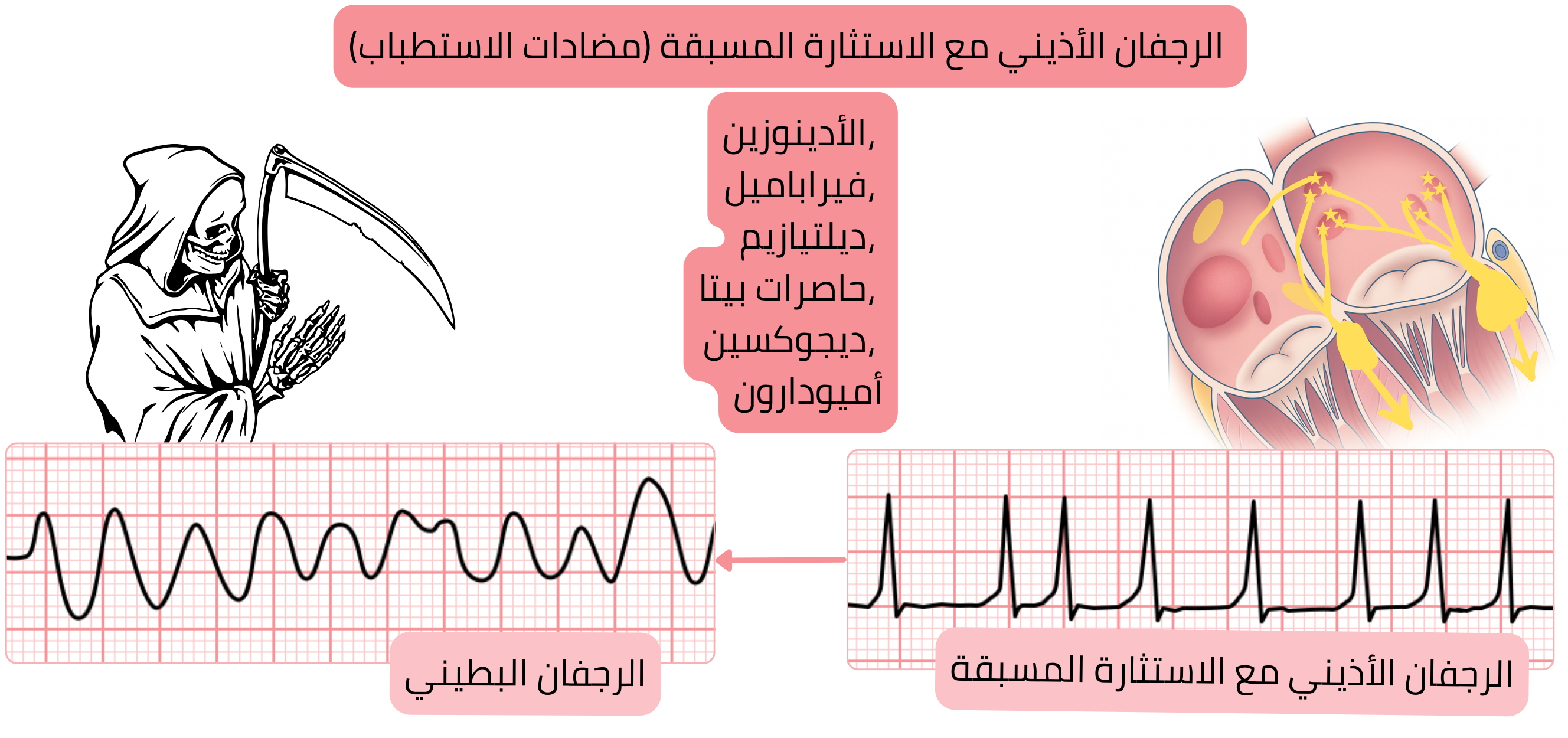 مخطط الرجفان الأذيني المُسبق الإثارة يوضح مضاد الاستطباب لأدوية العقدة الأذينية البطينية بسبب خطر التحول إلى الرجفان البطيني عند التوصيل عبر مسار إضافي.