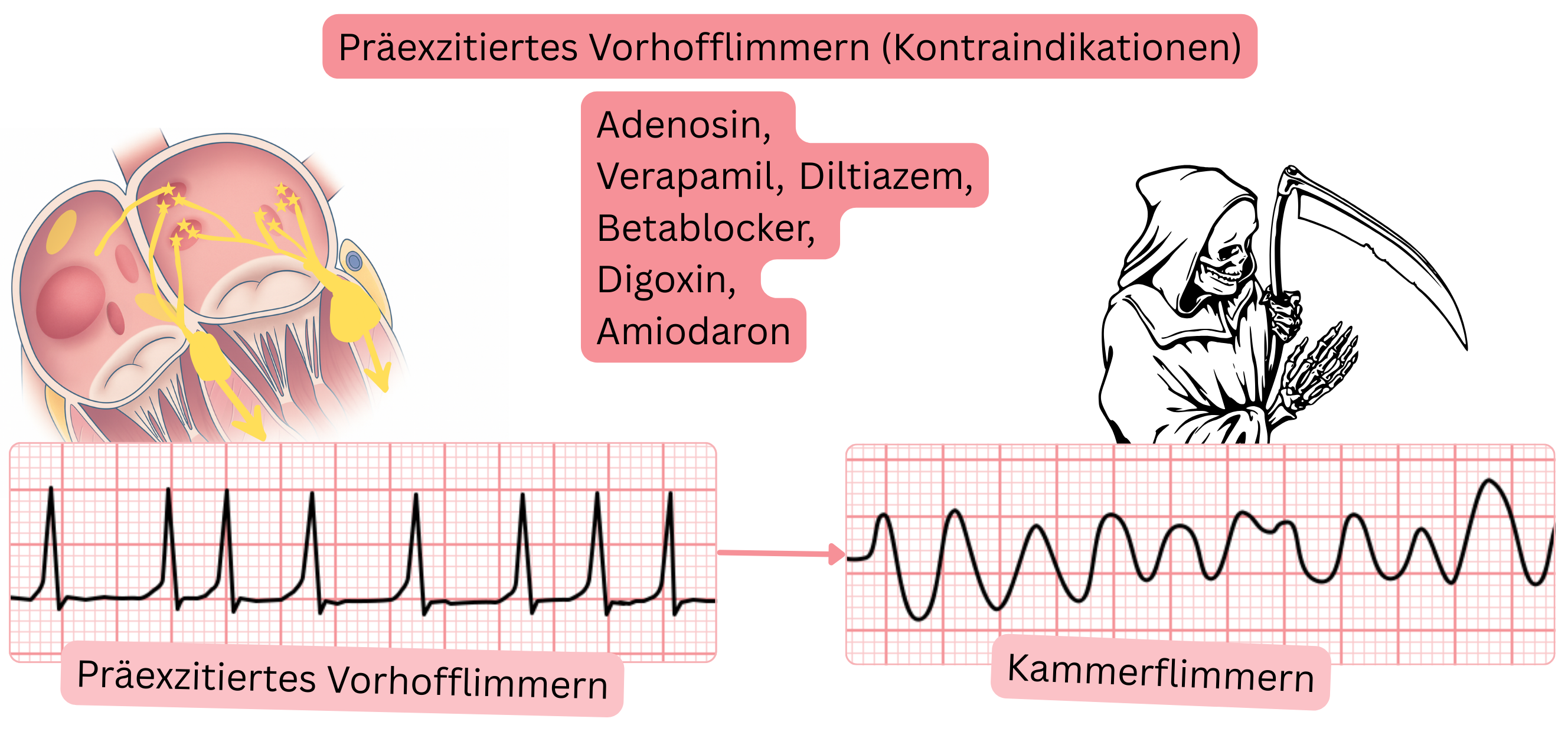 Schema der präexzitierten Vorhofflimmerns mit Darstellung der Kontraindikation von AV-knotenwirksamen Medikamenten aufgrund des Risikos eines Übergangs in Kammerflimmern bei Überleitung über eine akzessorische Bahn.