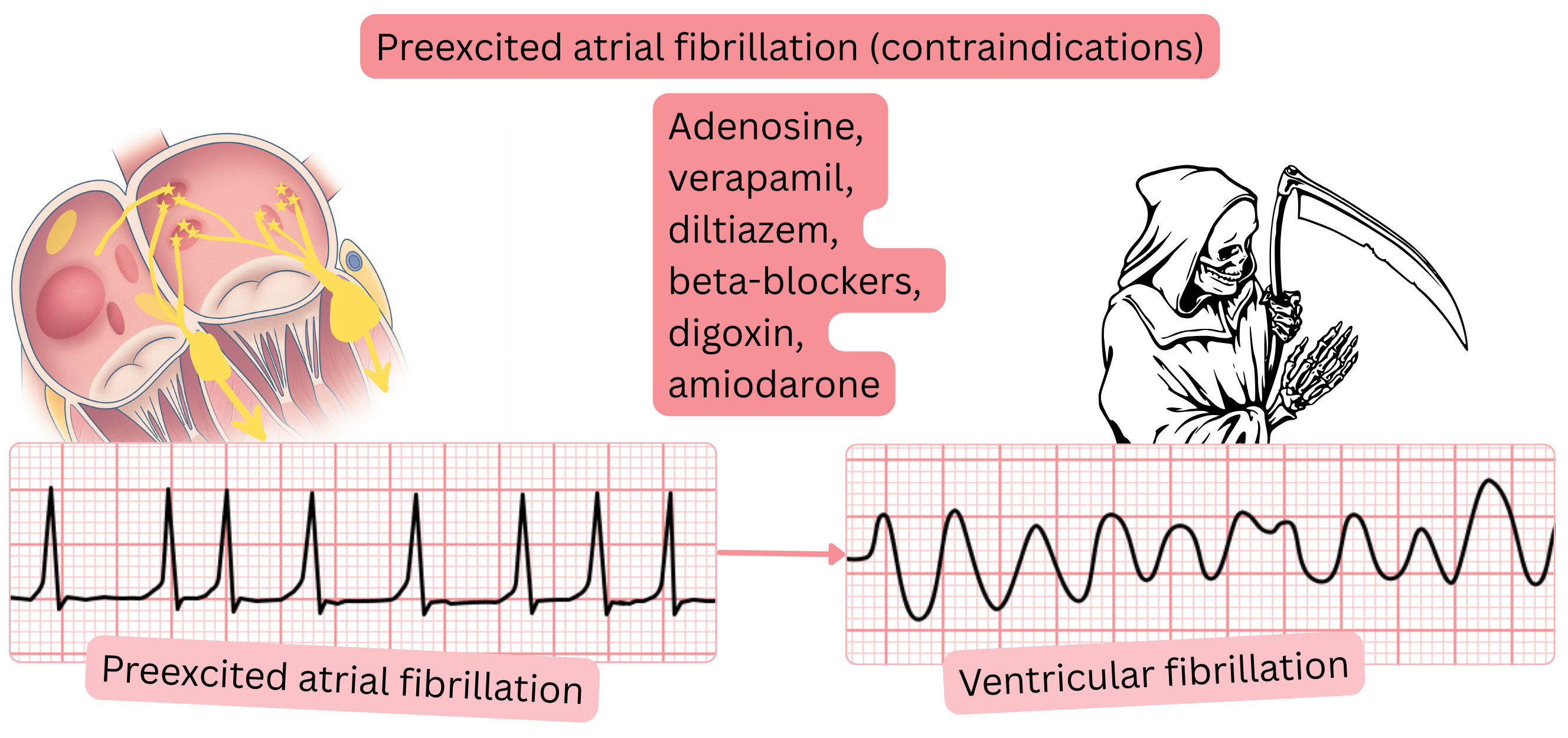 Diagram of preexcited atrial fibrillation illustrating the contraindication of AV nodal blocking drugs due to the risk of degeneration into ventricular fibrillation via conduction over an accessory pathway.