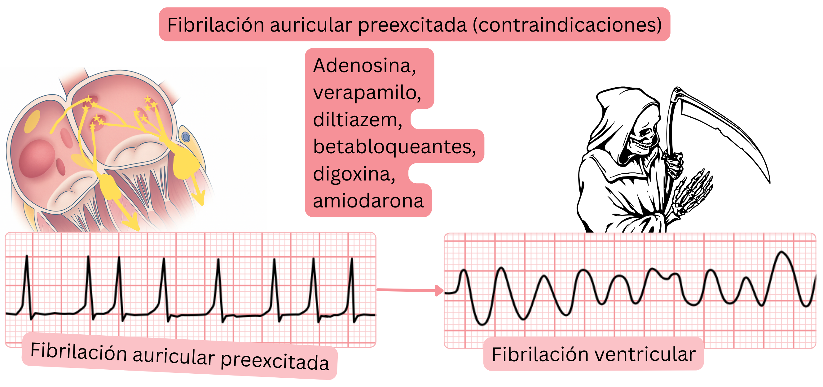 Esquema de la fibrilación auricular preexcitada que muestra la contraindicación de los fármacos que bloquean el nodo AV debido al riesgo de degeneración a fibrilación ventricular por conducción a través de una vía accesoria.