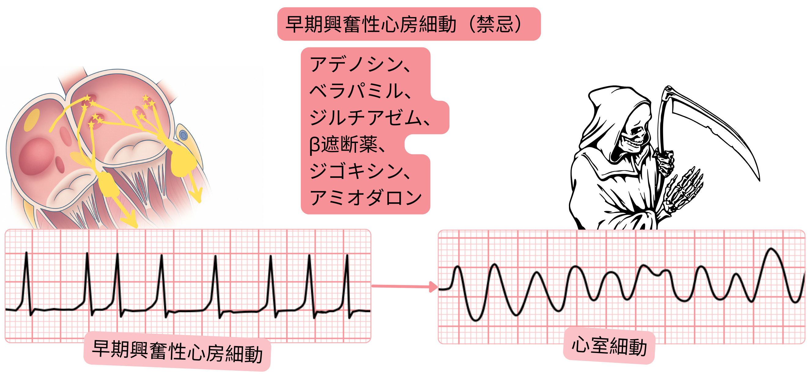 副伝導路を介した伝導により心室細動へ移行するリスクがあるため、房室結節作用薬が禁忌であることを示す前興奮性心房細動の模式図。