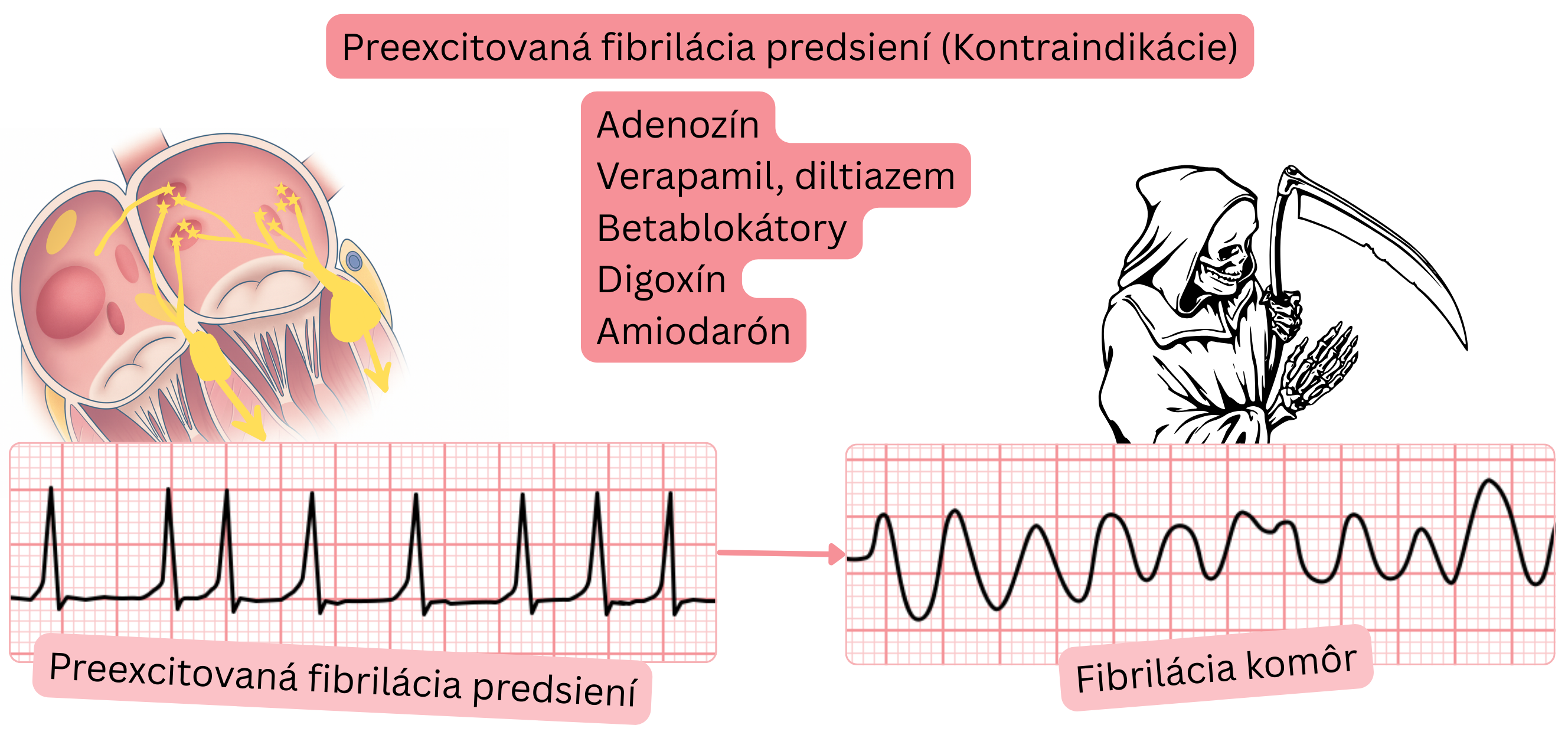 Schéma preexcitovanej fibrilácie predsiení znázorňujúca kontraindikáciu AV-uzlových liekov s rizikom prechodu do fibrilácie komôr pri vedení cez akcesórnu dráhu.