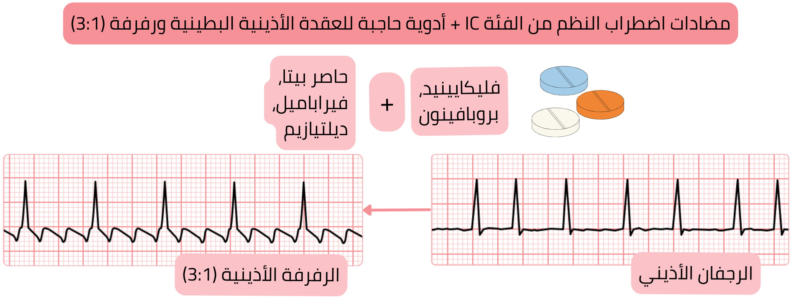 مخطط الجمع بين مضادات اضطراب النظم من الفئة IC والأدوية الحاصرة للعقدة الأذينية البطينية يوضح تحول الرجفان الأذيني إلى رفرفة أذينية مع توصيل مضبوط بنسبة 3:1.