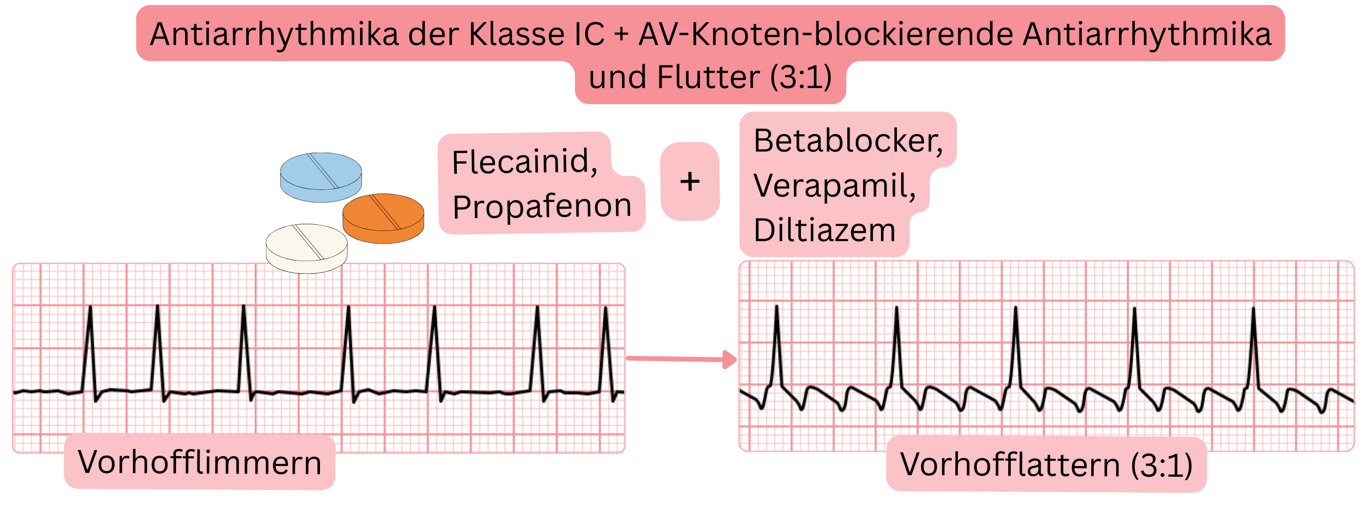 Schema der Kombination von Antiarrhythmika der Klasse IC mit AV-knotenblockierenden Medikamenten, das den Übergang von Vorhofflimmern zu Vorhofflattern mit kontrollierter 3:1-Überleitung darstellt.