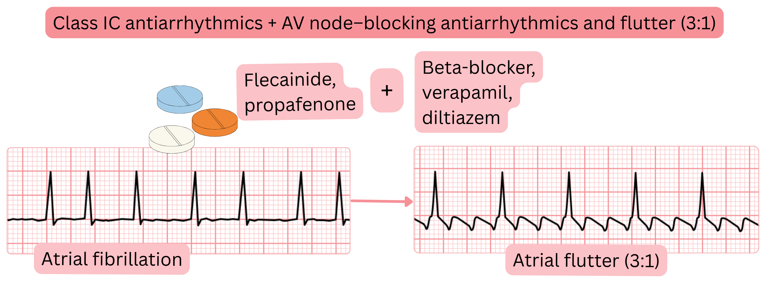 Diagram illustrating combination therapy with class IC antiarrhythmic drugs and atrioventricular nodal blocking agents showing conversion of atrial fibrillation to atrial flutter with controlled 3:1 conduction.