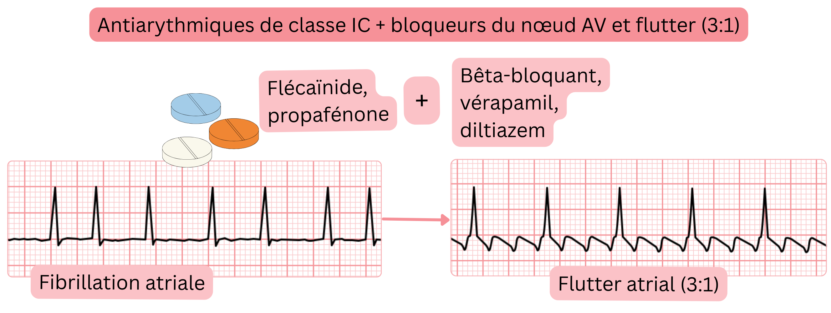 Schéma de la combinaison d’antiarythmiques de classe IC avec des médicaments bloquant le nœud auriculoventriculaire illustrant la conversion de la fibrillation auriculaire en flutter auriculaire avec conduction contrôlée 3:1.