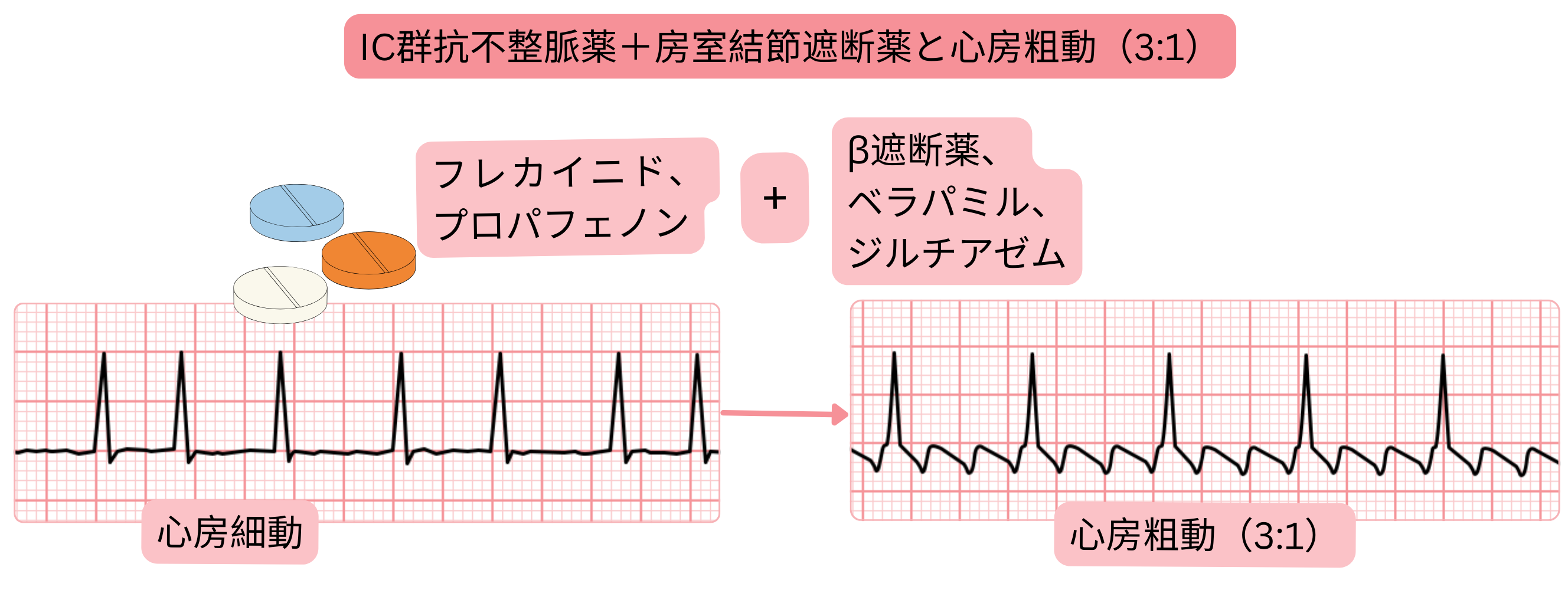 IC群抗不整脈薬と房室結節遮断薬の併用により、心房細動が制御された3:1房室伝導を伴う心房粗動へ移行することを示す模式図。