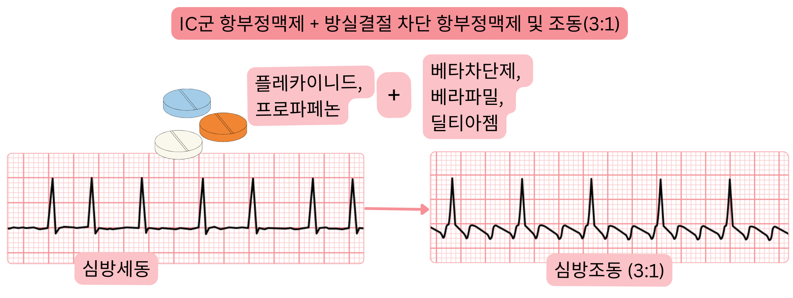 IC군 항부정맥제와 방실결절 차단 약물의 병용으로 심방세동이 조절된 3:1 방실 전도를 동반한 심방조동으로 전환되는 것을 보여주는 도식.
