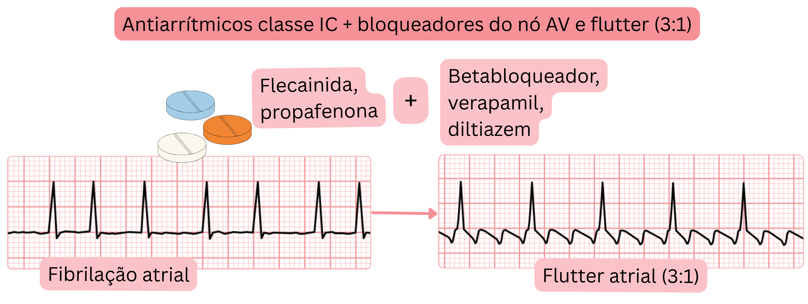 Esquema da combinação de antiarrítmicos de classe IC com fármacos bloqueadores do nó atrioventricular demonstrando a conversão da fibrilação atrial em flutter atrial com condução controlada 3:1.