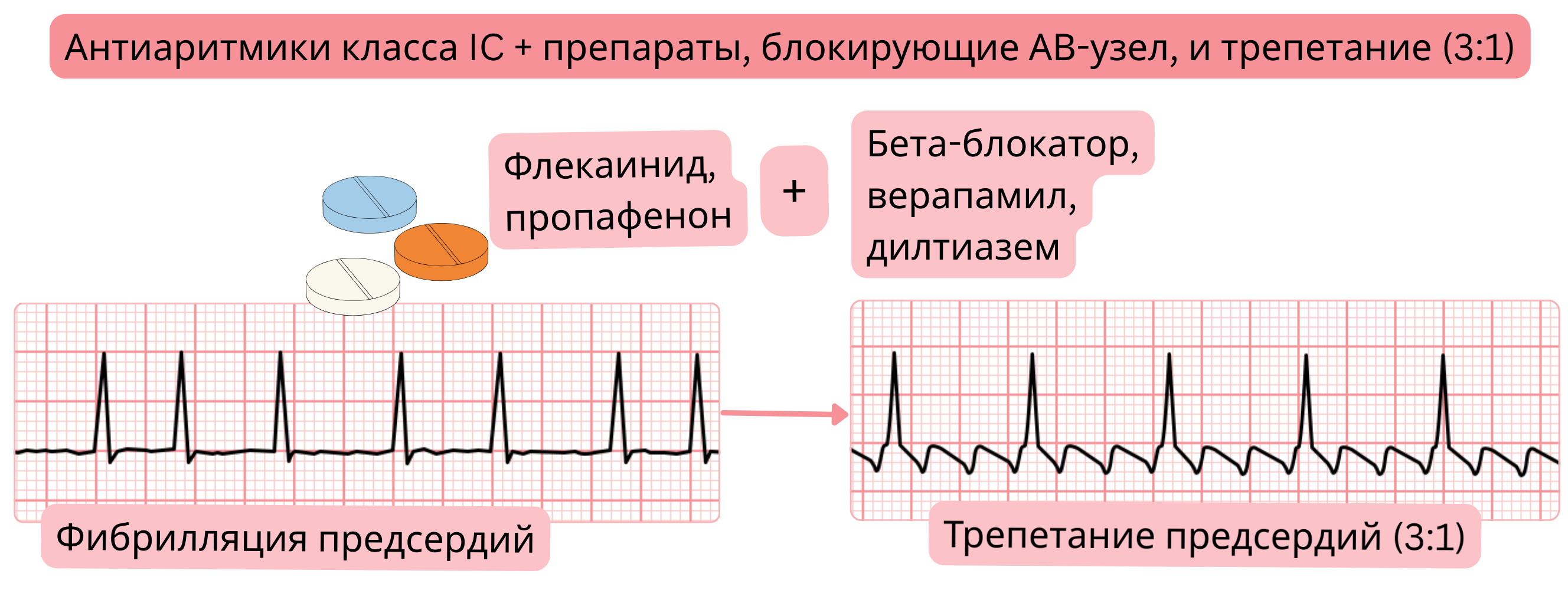 Схема комбинации антиаритмических препаратов класса IC с лекарствами, блокирующими атриовентрикулярный узел, демонстрирующая переход фибрилляции предсердий в трепетание предсердий с контролируемым проведением 3:1.