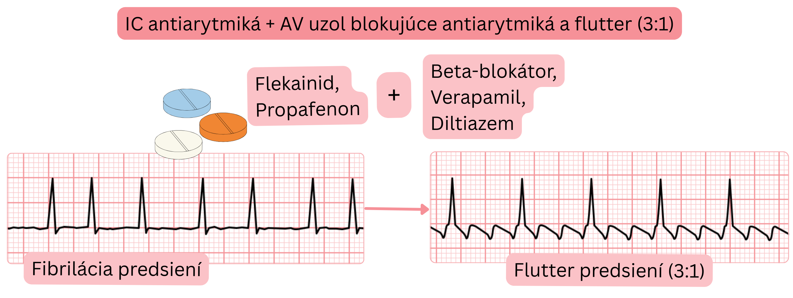 Schéma kombinácie antiarytmík triedy IC s liekmi blokujúcimi atrioventrikulárny uzol znázorňujúca prechod fibrilácie predsiení do predsieňového flutteru s riadeným vedením 3 : 1.