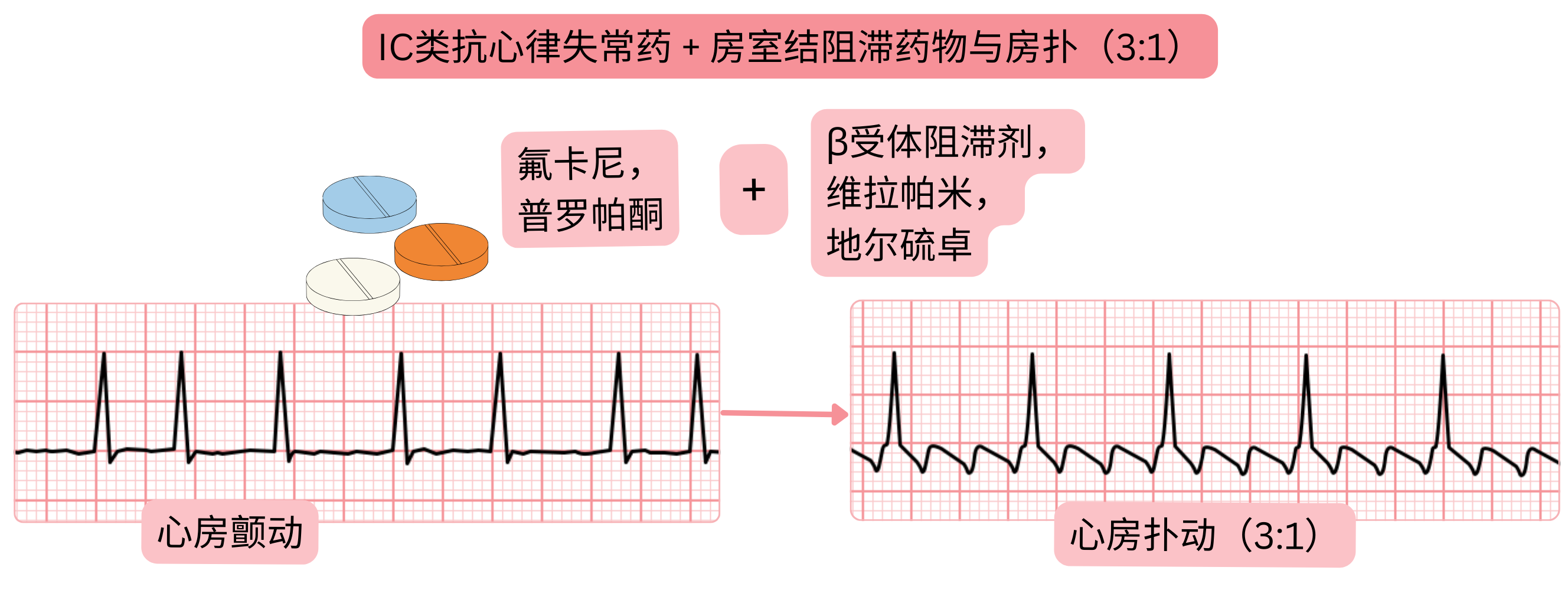IC类抗心律失常药物联合房室结阻滞药物的示意图，显示心房颤动转变为心房扑动，并出现受控的3:1房室传导。