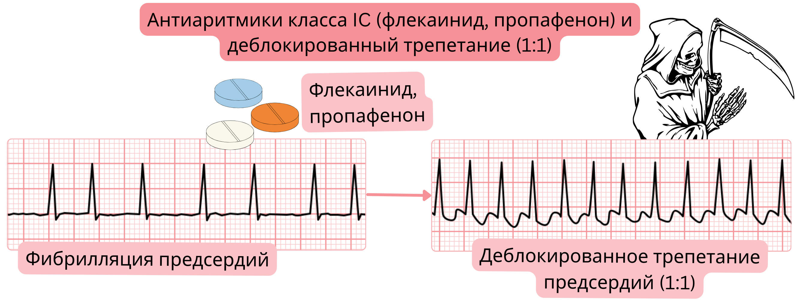 Схема действия антиаритмических препаратов класса IC (флекаинид, пропафенон), демонстрирующая риск перехода фибрилляции предсердий в неблокированное трепетание предсердий с проведением 1:1 при отсутствии блокады AV-узла.
