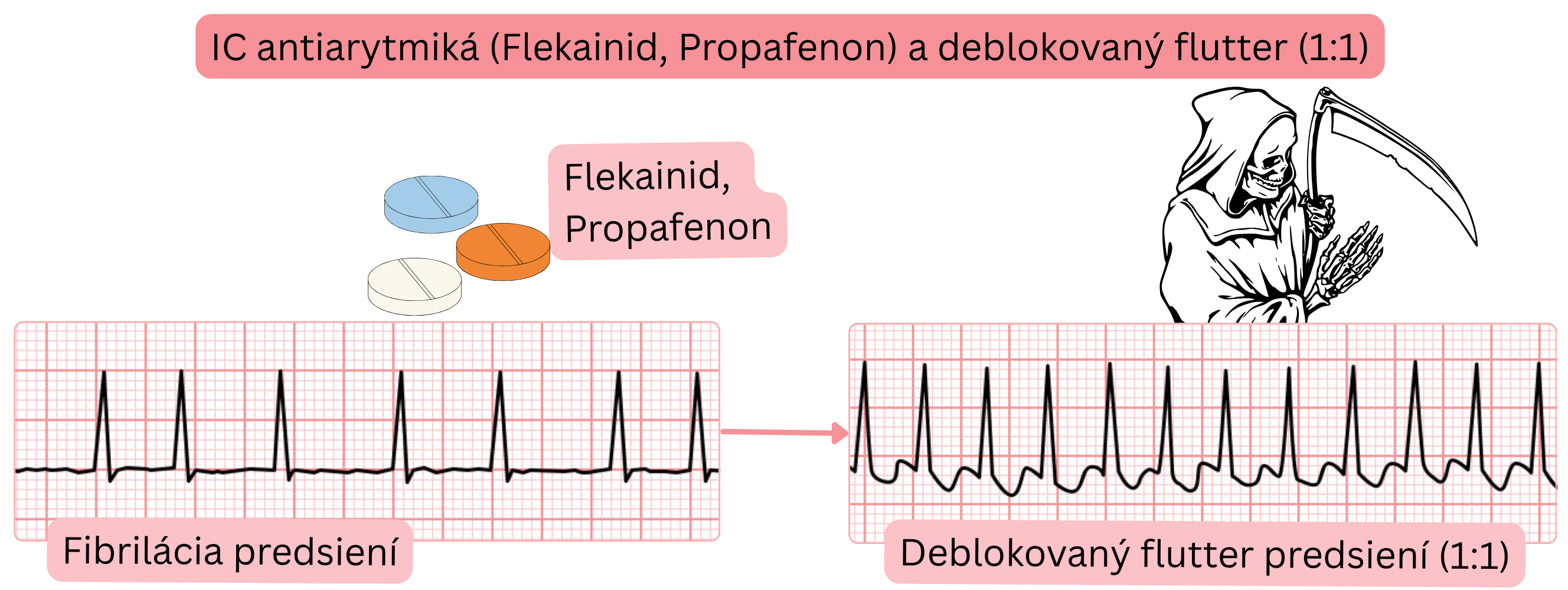 Schéma účinku antiarytmík triedy IC (flekainid, propafenón) znázorňujúca riziko prechodu fibrilácie predsiení do deblokovaného predsieňového flutteru s vedením 1 : 1 pri absencii blokády AV uzla.