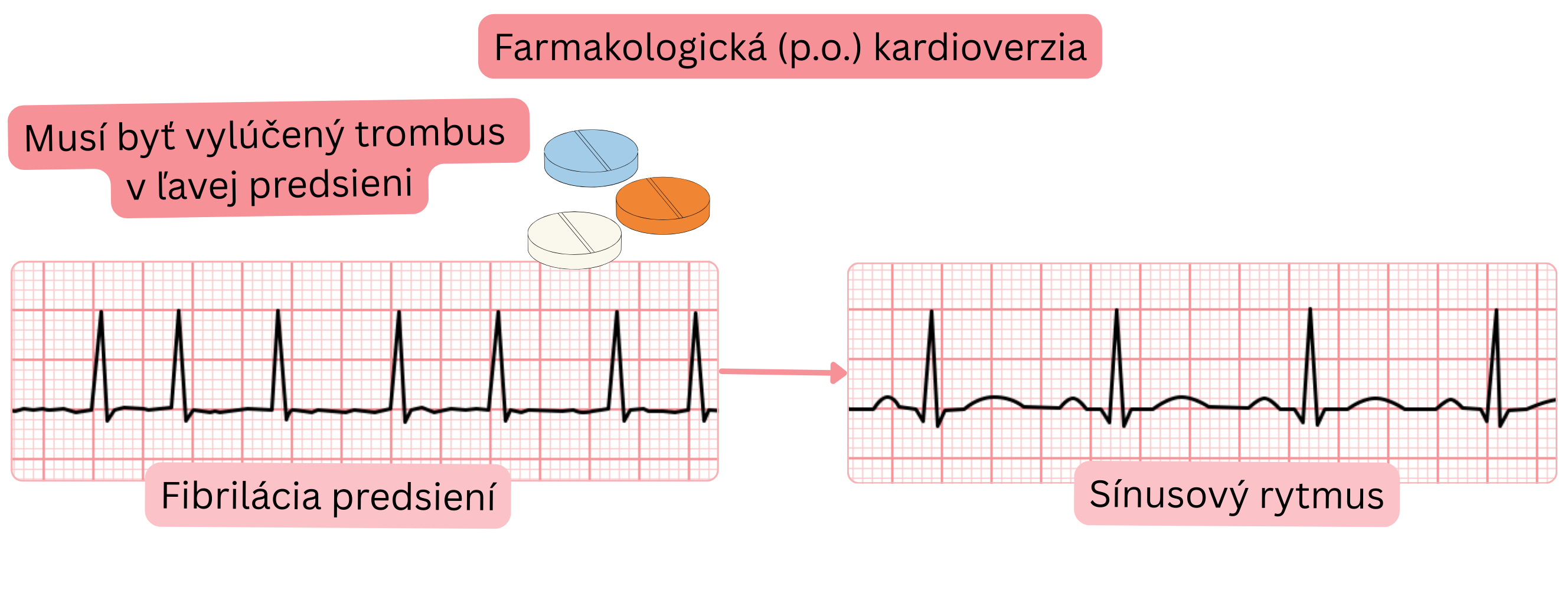 Schéma farmakologickej kardioverzie fibrilácie predsiení perorálnymi antiarytmikami s nutnosťou vylúčenia trombu v ľavej predsieni pred obnovením sínusového rytmu.