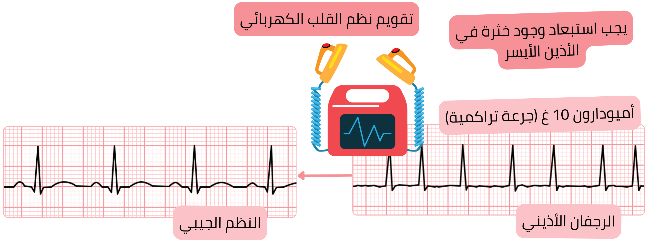 مخطط التقويم القلبي الكهربائي للرجفان الأذيني بعد التحميل المسبق بالأميودارون، مع التأكيد على ضرورة استبعاد خثرة في الأذين الأيسر قبل استعادة النظم الجيبي.