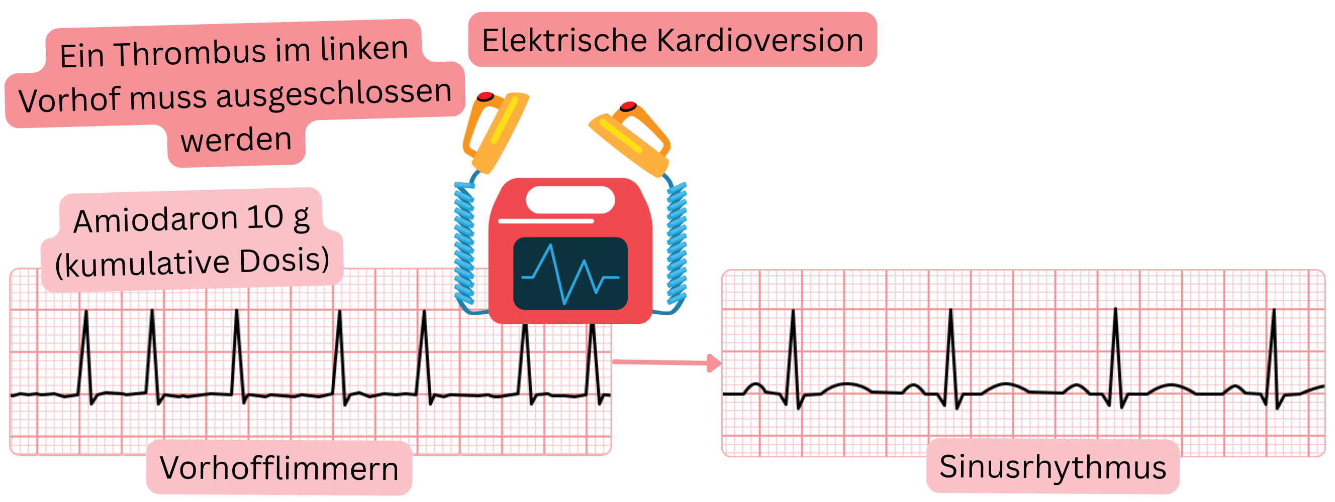 Schema der elektrischen Kardioversion von Vorhofflimmern nach vorheriger Aufsättigung mit Amiodaron mit Notwendigkeit des Ausschlusses eines Thrombus im linken Vorhof vor Wiederherstellung des Sinusrhythmus.