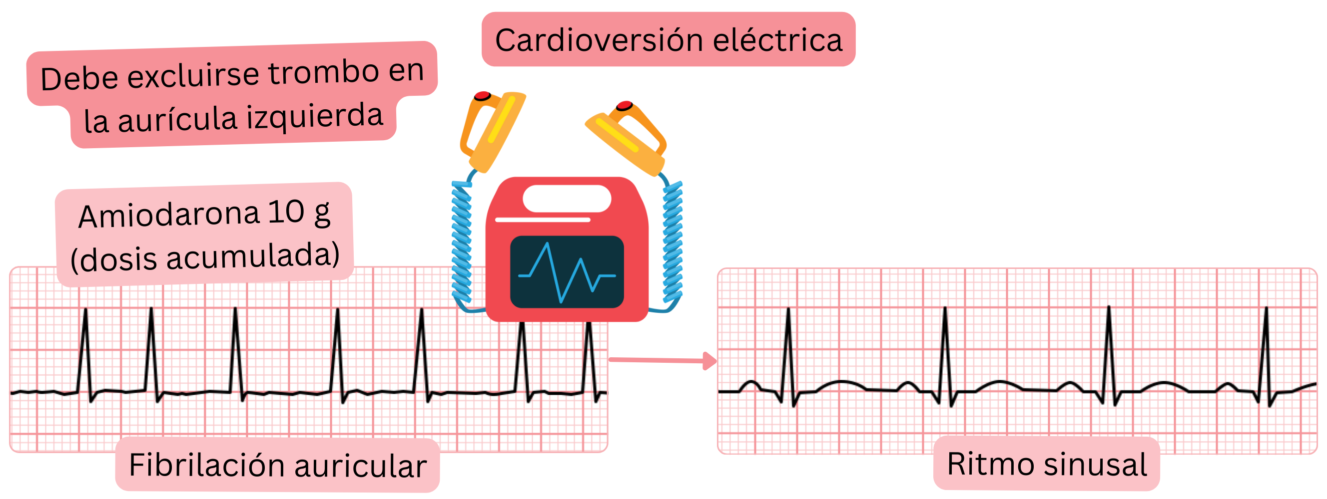 Esquema de la cardioversión eléctrica de la fibrilación auricular tras carga previa con amiodarona, destacando la necesidad de excluir trombo en la aurícula izquierda antes de restaurar el ritmo sinusal.