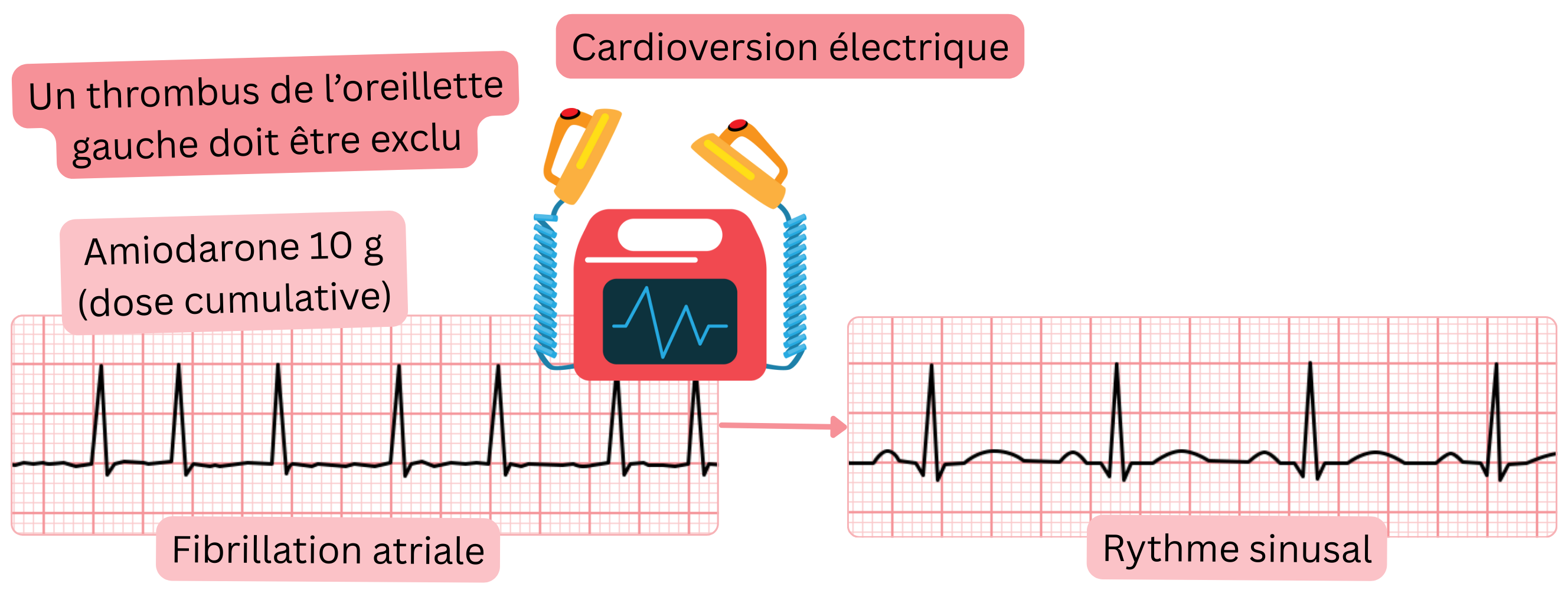 Schéma de la cardioversion électrique de la fibrillation auriculaire après charge préalable en amiodarone, soulignant la nécessité d’exclure un thrombus de l’oreillette gauche avant le rétablissement du rythme sinusal.