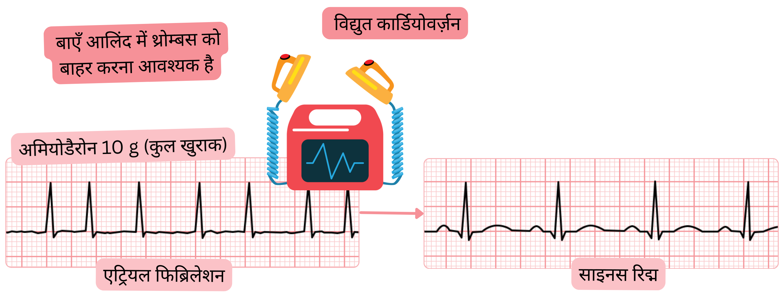 अमियोडैरोन से पूर्व नस्यकरण के बाद एट्रियल फिब्रिलेशन की इलेक्ट्रिकल कार्डियोवर्ज़न का आरेख, जिसमें साइनस रिद्म की पुनःस्थापना से पहले बाएँ एट्रियम में थ्रोम्बस को排除 करने की आवश्यकता दर्शाई गई है।