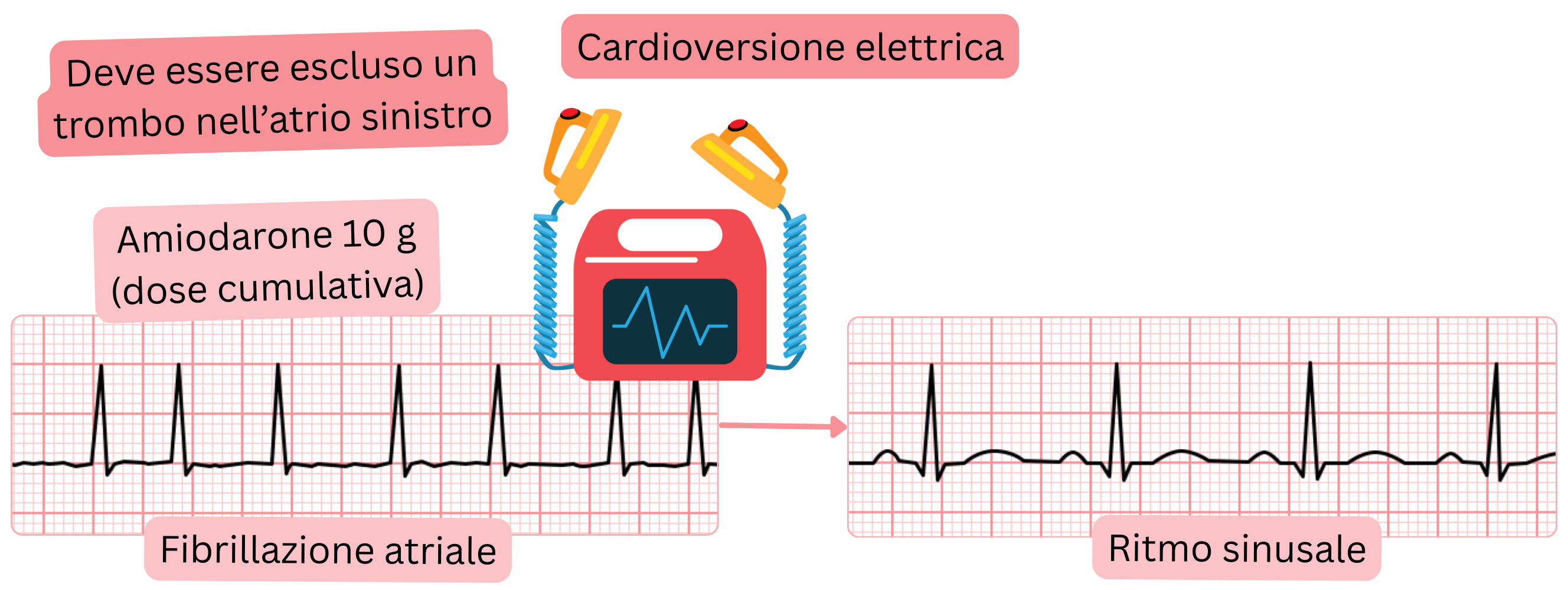 Schema della cardioversione elettrica della fibrillazione atriale dopo carico preliminare con amiodarone, evidenziando la necessità di escludere un trombo nell’atrio sinistro prima del ripristino del ritmo sinusale.