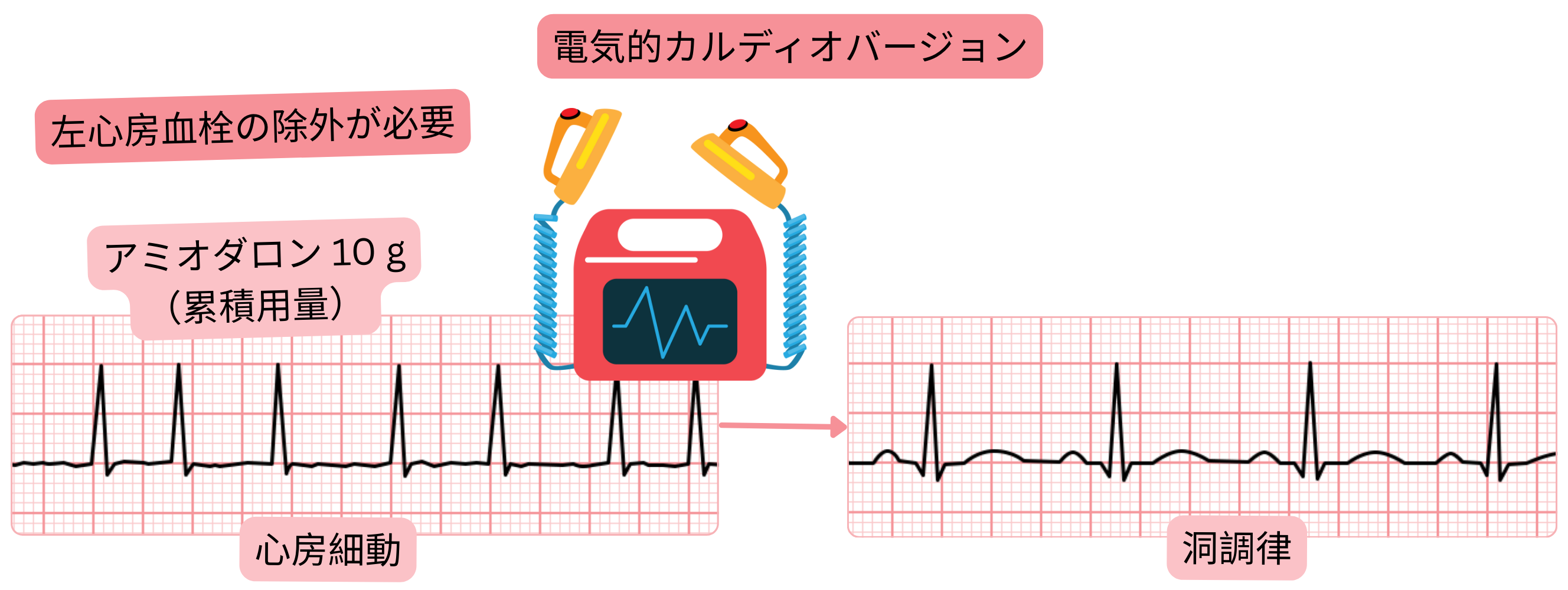 アミオダロンによる事前負荷後に行う心房細動の電気的カルディオバージョンを示す模式図で、洞調律回復前に左心房血栓を除外する必要性を示す。