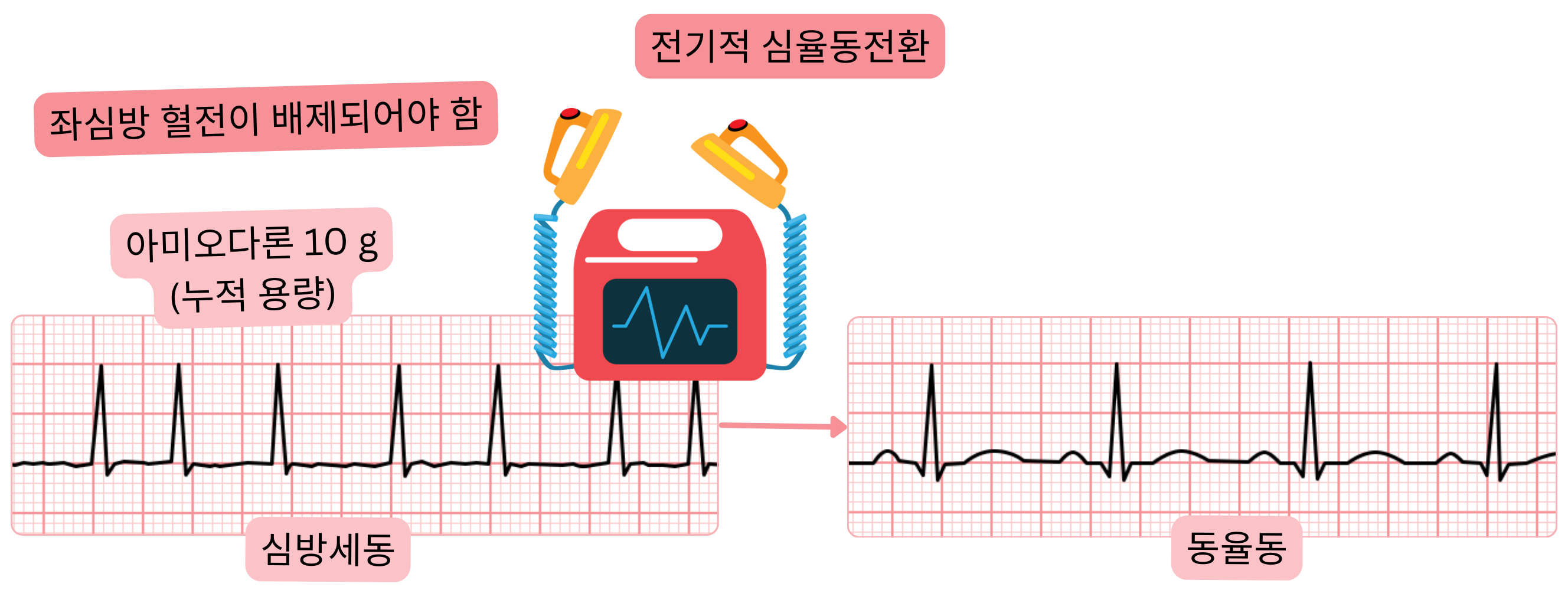 아미오다론 선행 적재 후 시행하는 심방세동의 전기적 심율동전환을 나타낸 도식으로, 동율동 회복 전에 좌심방 혈전 배제가 필요함을 보여준다.