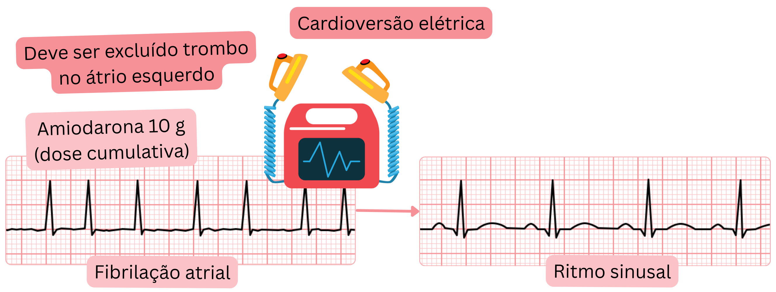 Esquema da cardioversão elétrica da fibrilação atrial após carga prévia com amiodarona, ressaltando a necessidade de excluir trombo no átrio esquerdo antes da restauração do ritmo sinusal.