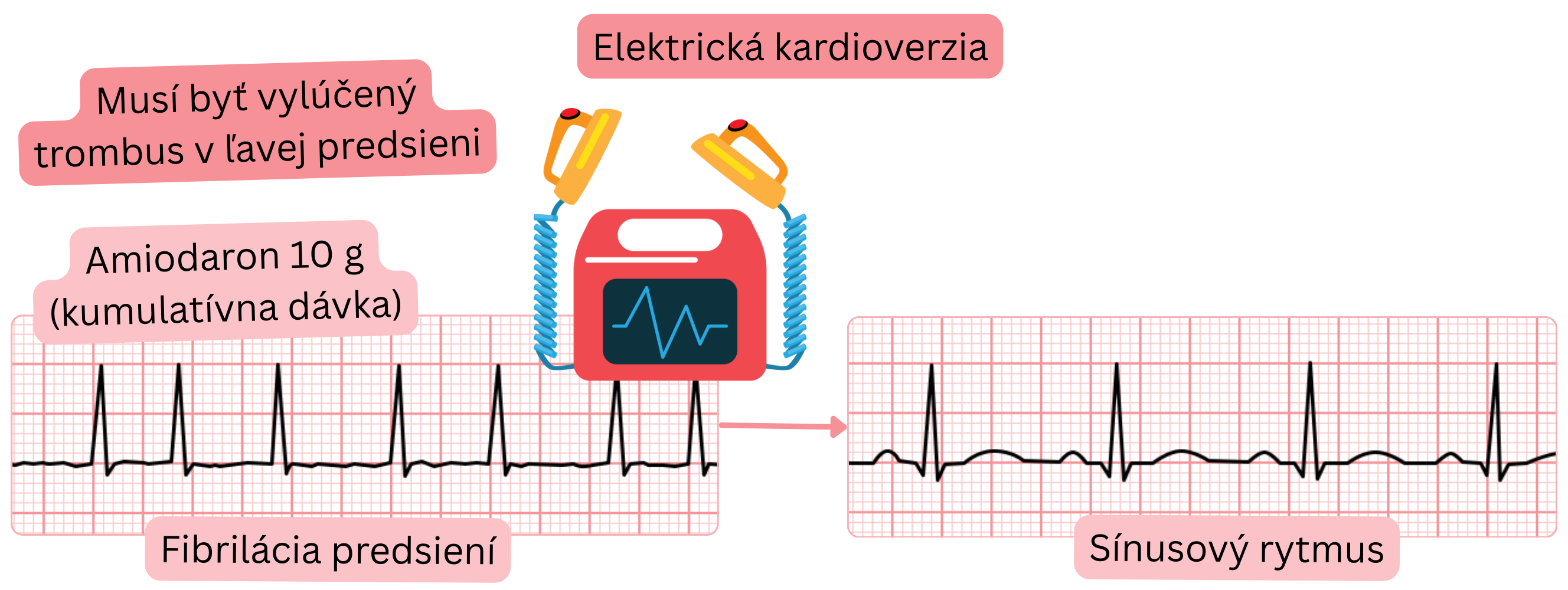 Schéma elektrickej kardioverzie fibrilácie predsiení po predchádzajúcom nasytení amiodarónom s nutnosťou vylúčenia trombu v ľavej predsieni pred obnovením sínusového rytmu.