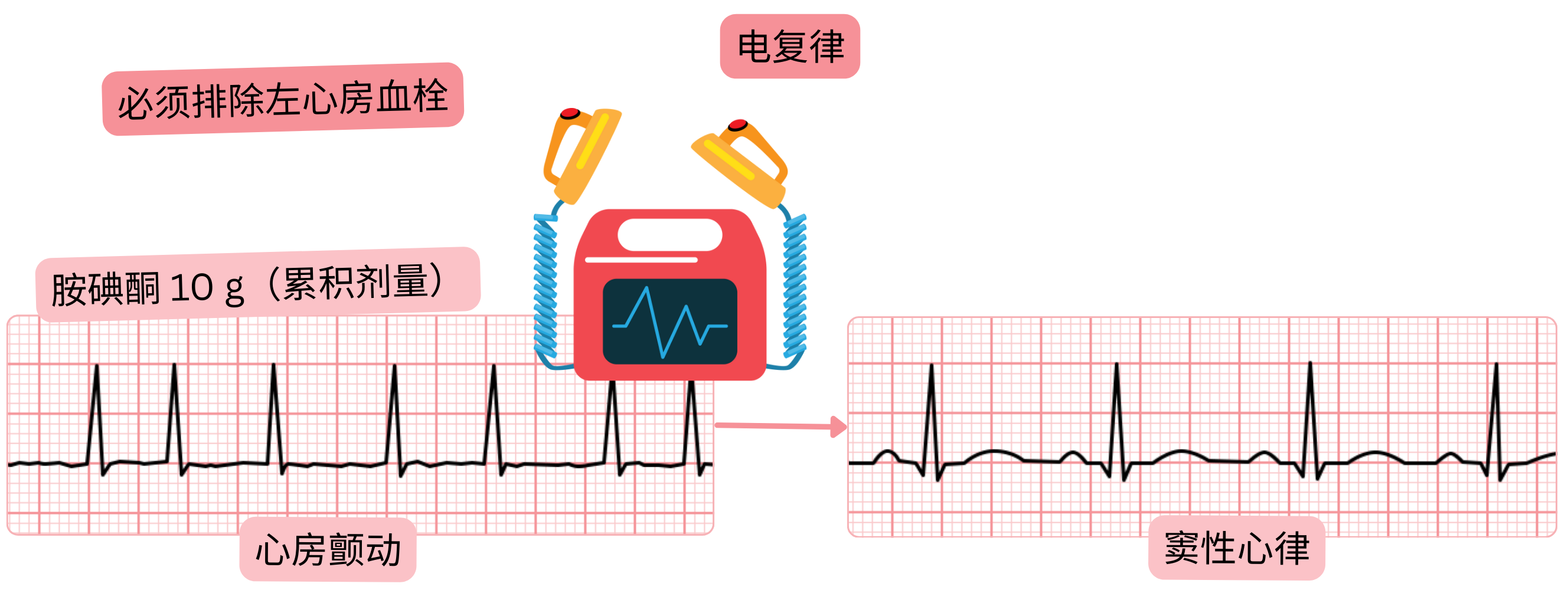 在先行胺碘酮负荷治疗后进行心房颤动电复律的示意图，强调在恢复窦性心律前需排除左心房血栓。
