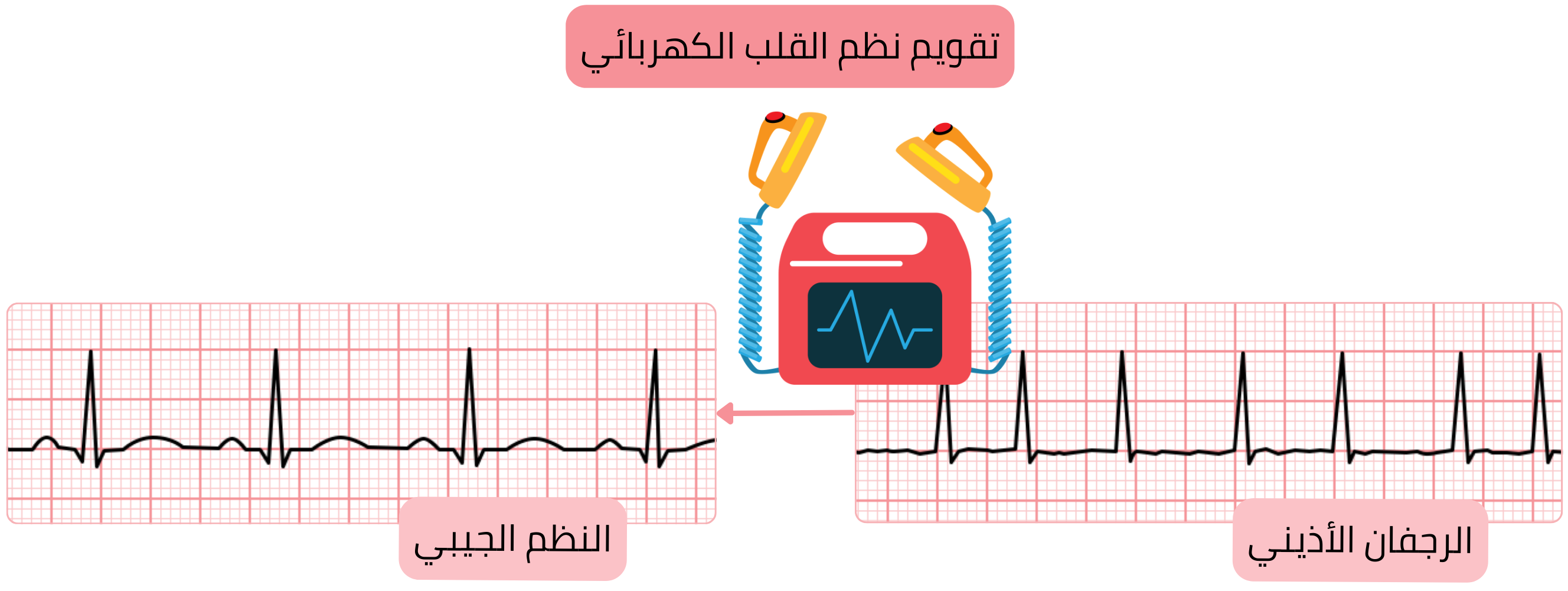 مخطط التقويم القلبي الكهربائي يوضح استعادة النظم الجيبي من الرجفان الأذيني باستخدام صدمة كهربائية متزامنة.