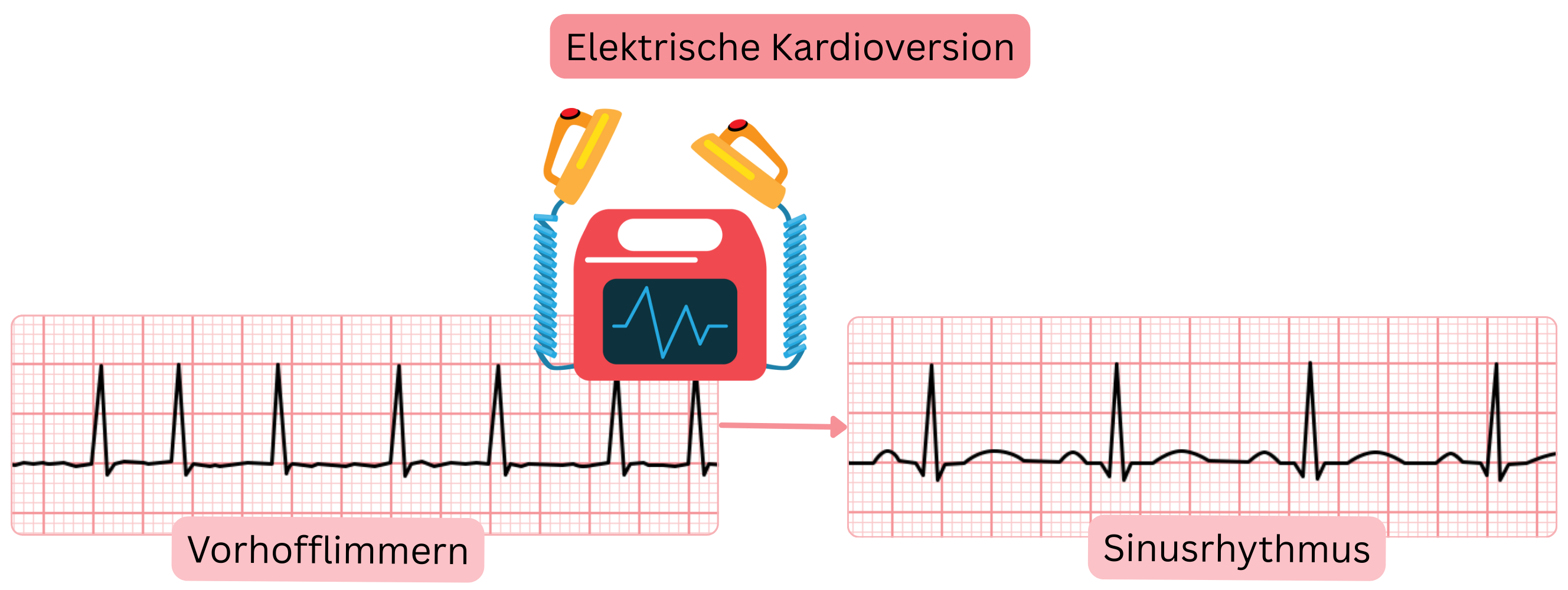 Schema der elektrischen Kardioversion mit Darstellung der Wiederherstellung des Sinusrhythmus aus Vorhofflimmern mittels synchronisiertem elektrischem Schock.