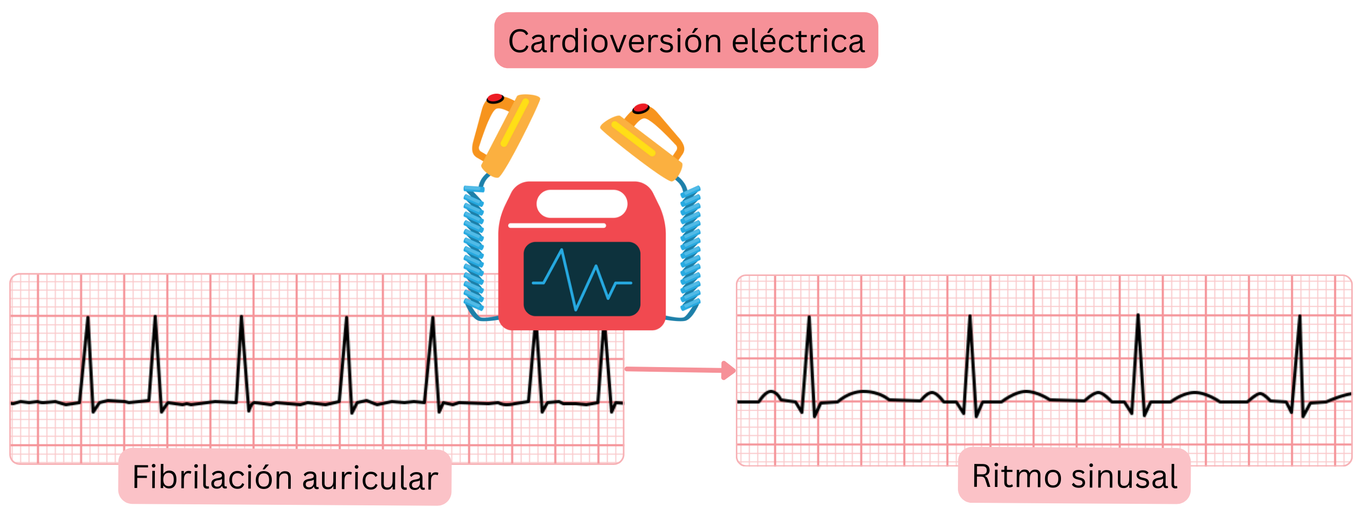 Esquema de la cardioversión eléctrica que muestra la restauración del ritmo sinusal a partir de la fibrilación auricular mediante una descarga eléctrica sincronizada.