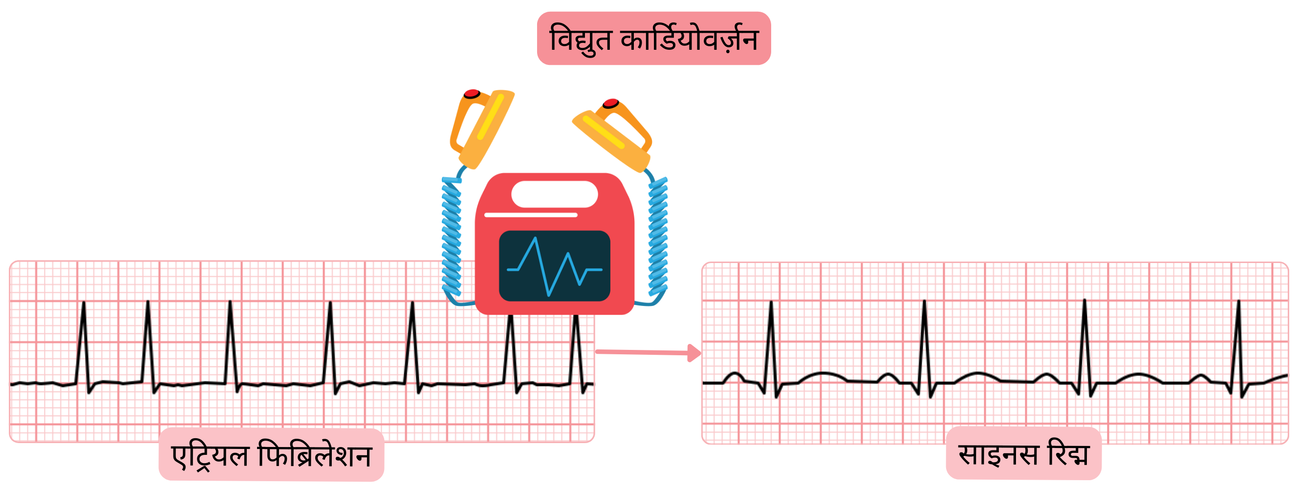 इलेक्ट्रिकल कार्डियोवर्ज़न का आरेख, जिसमें सिंक्रोनाइज़्ड इलेक्ट्रिक शॉक द्वारा एट्रियल फिब्रिलेशन से साइनस रिद्म की बहाली दर्शाई गई है।