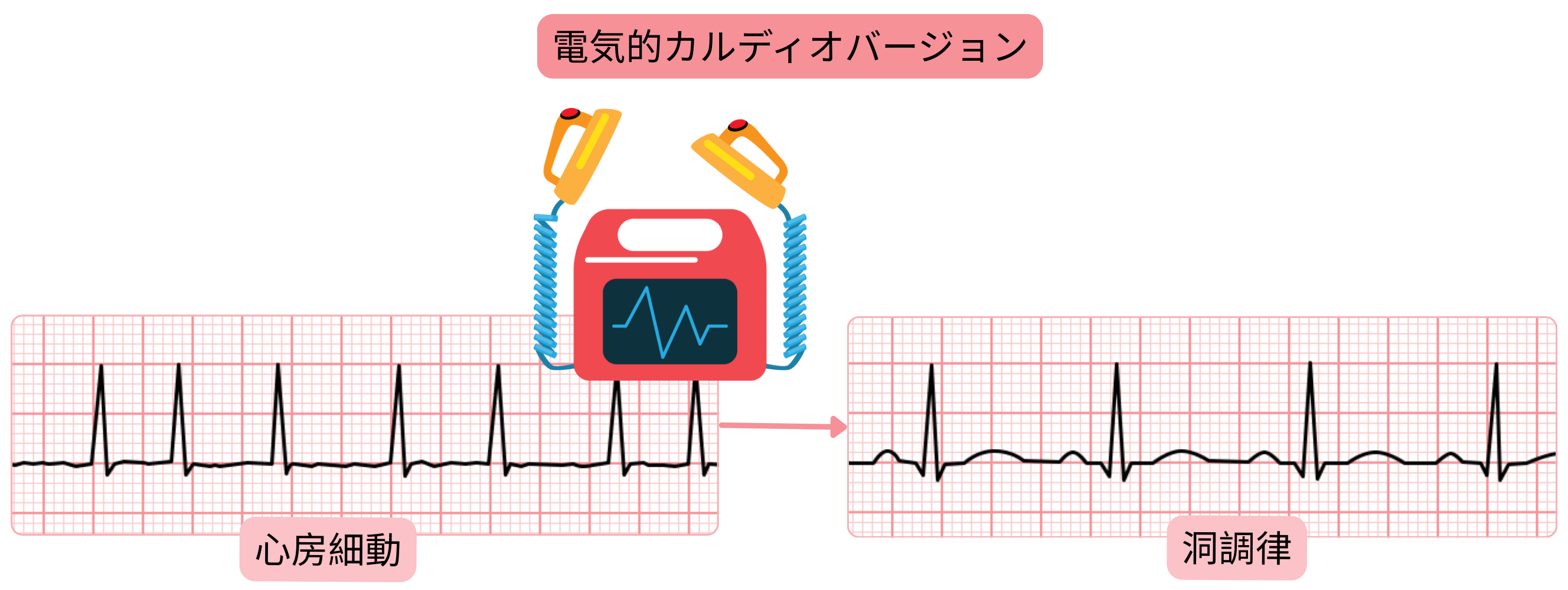 同期電気ショックを用いて心房細動から洞調律を回復させる電気的カルディオバージョンを示す模式図。