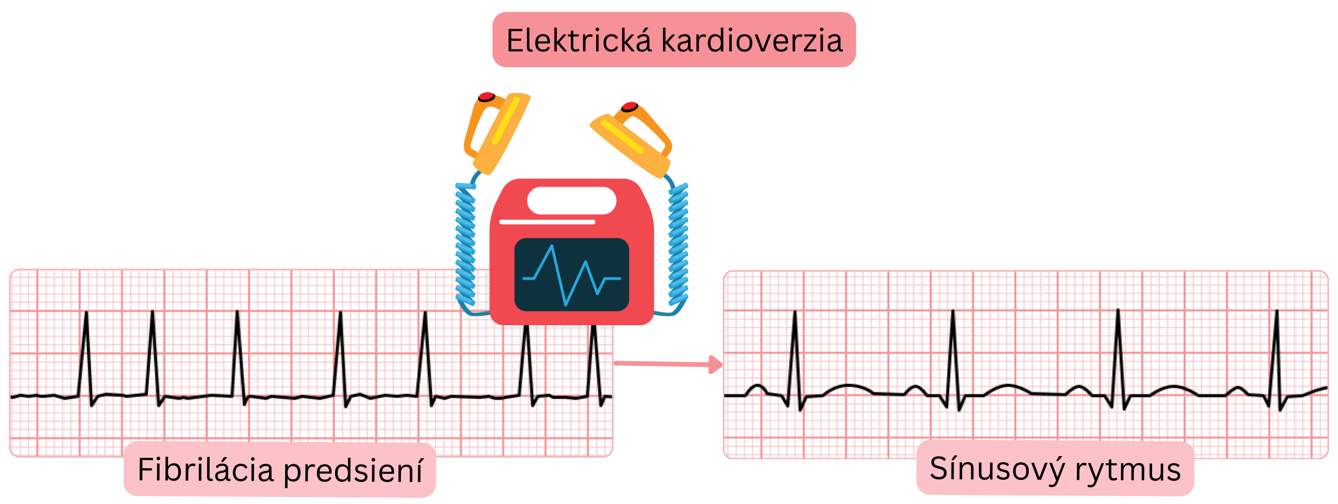 Schéma elektrickej kardioverzie znázorňujúca obnovenie sínusového rytmu z fibrilácie predsiení pomocou synchronizovaného elektrického výboja.