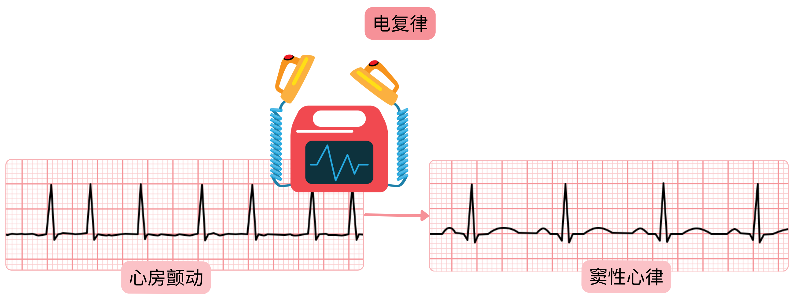 电复律示意图，显示通过同步电击将心房颤动恢复为窦性心律。