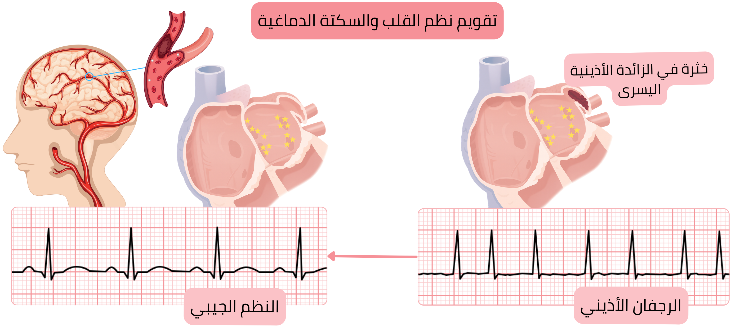 مخطط يوضح خطر السكتة الدماغية بعد تقويم نظم الرجفان الأذيني نتيجة انصمام خثرة من زائدة الأذين الأيسر عند استعادة النظم الجيبي.